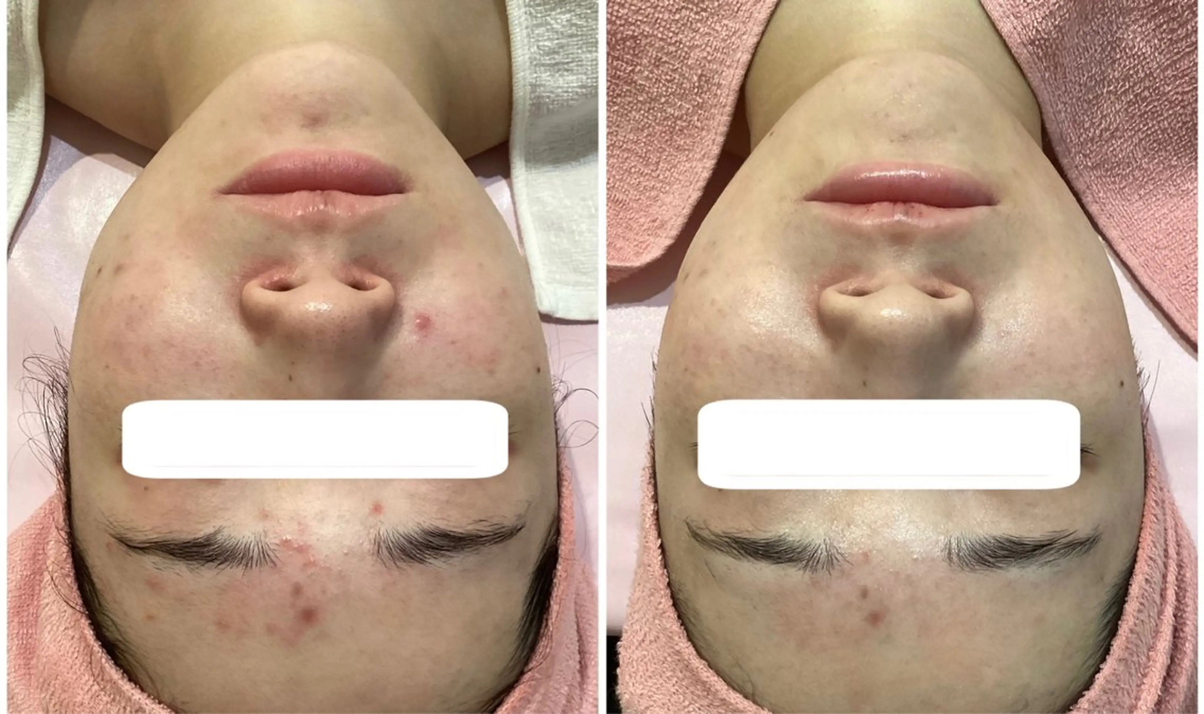 【毛穴革命！】バクテリウムピールで短期集中！毛穴、シミ改善、シワ改善✨お肌を育てる施術です💡の写真