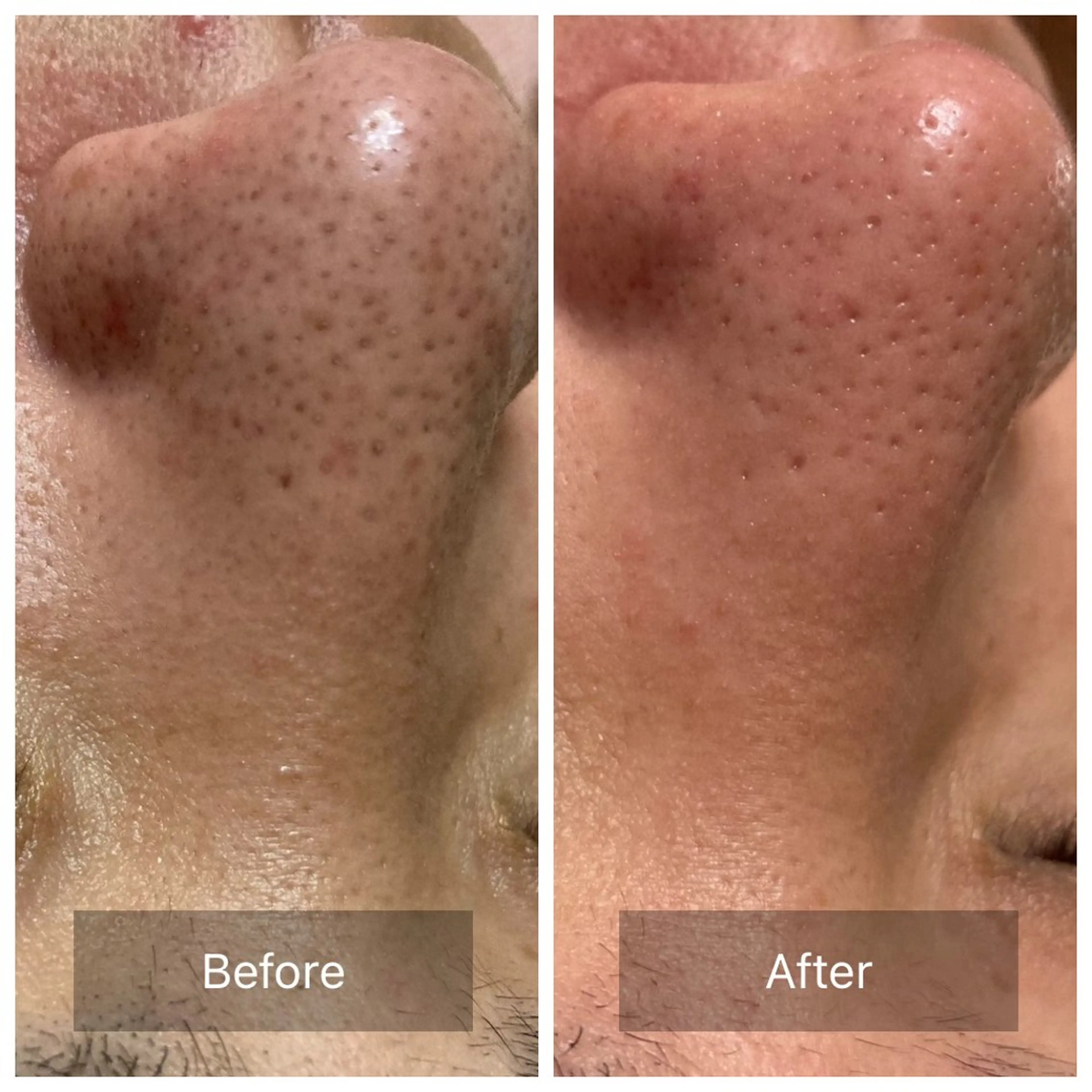 【人気NO1☆黒ずみ/開き/たるみ毛穴ケア】韓国式3D毛穴洗浄＋引き締め美容液の写真