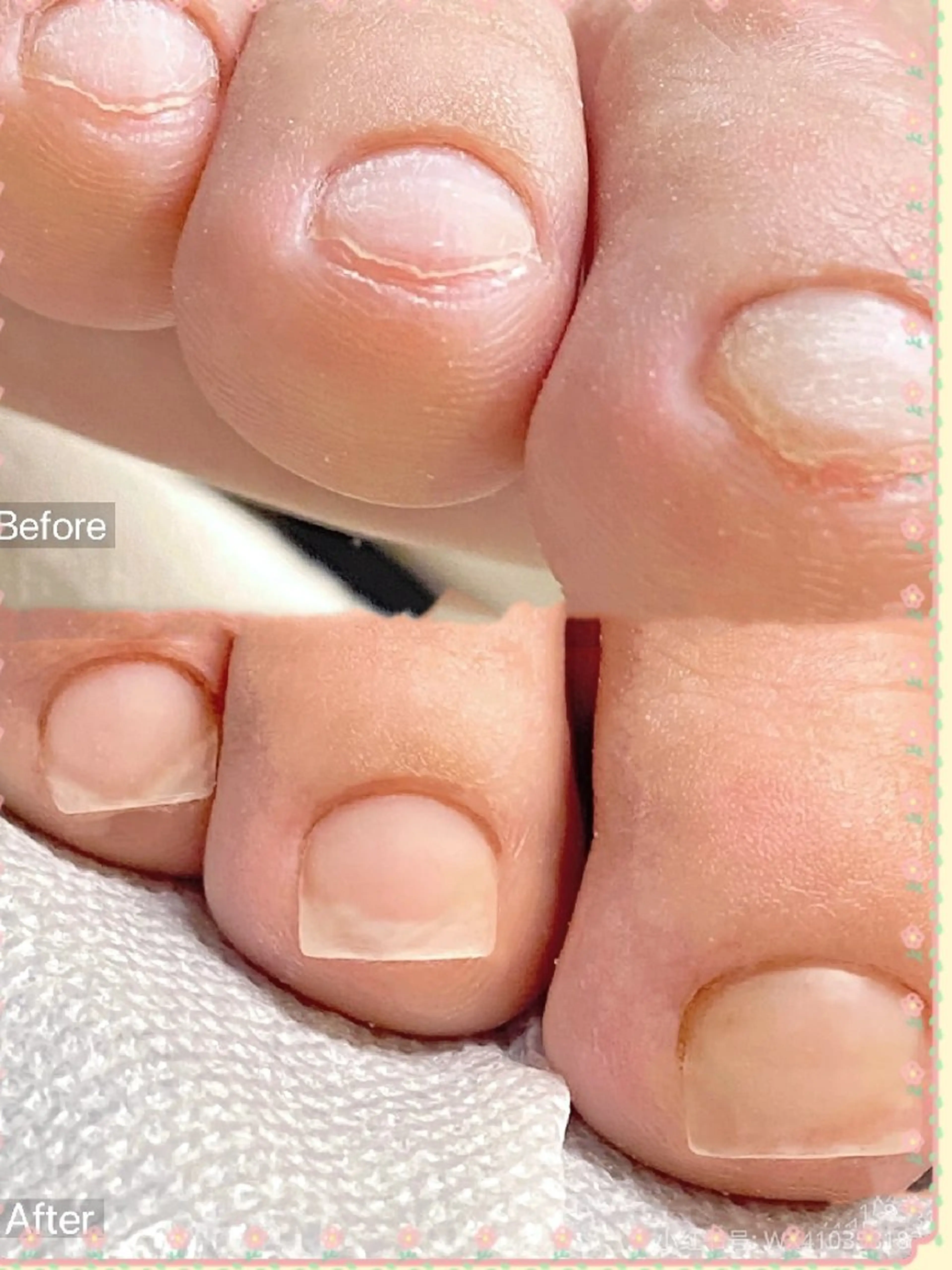 ネイル フットネイル フットネイル ネイリストゆか💅 長さだし、深爪矯正のネイルデザイン