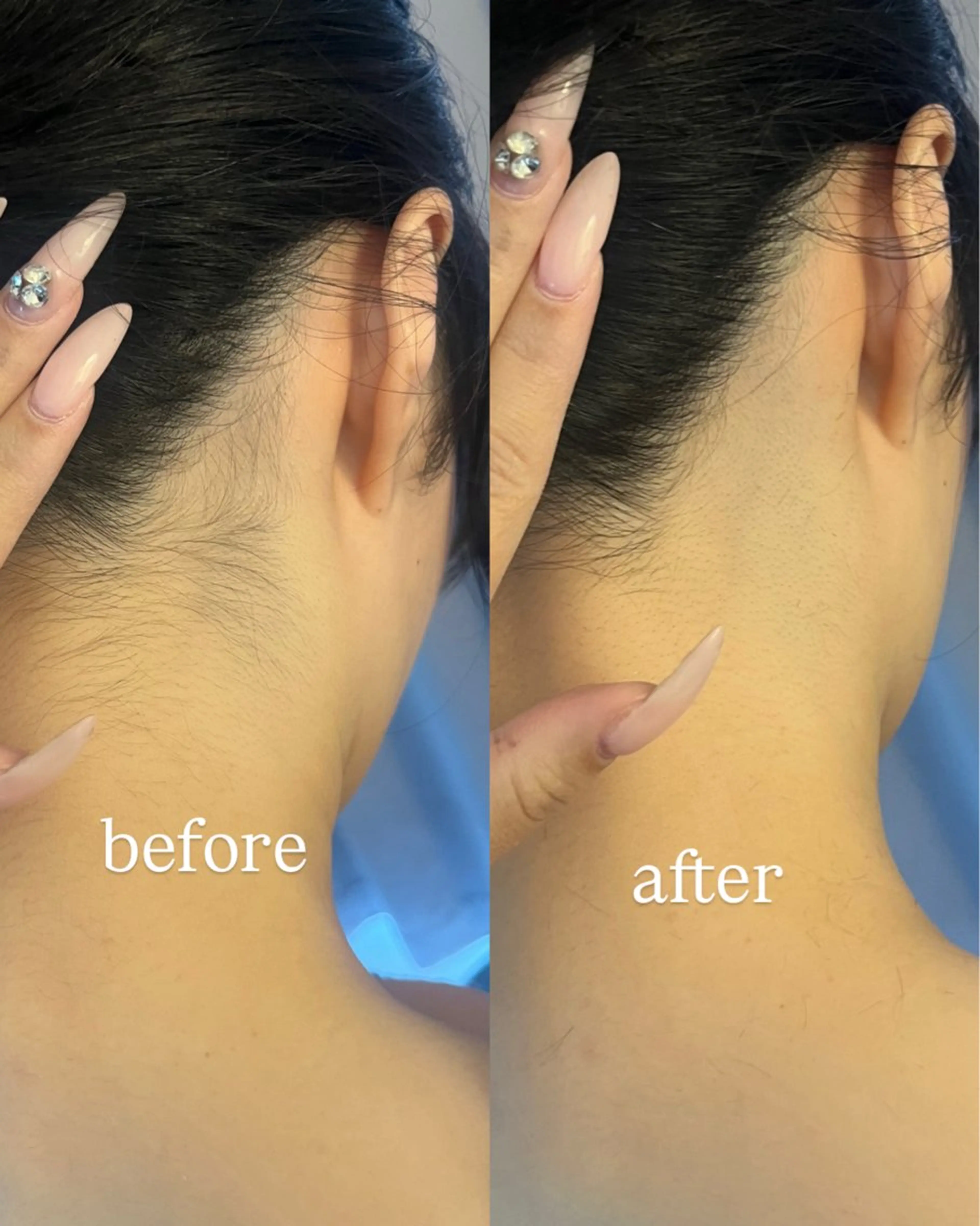 脱毛 うなじ脱毛/美肌脱毛 LABELのエステ・リラクイメージ