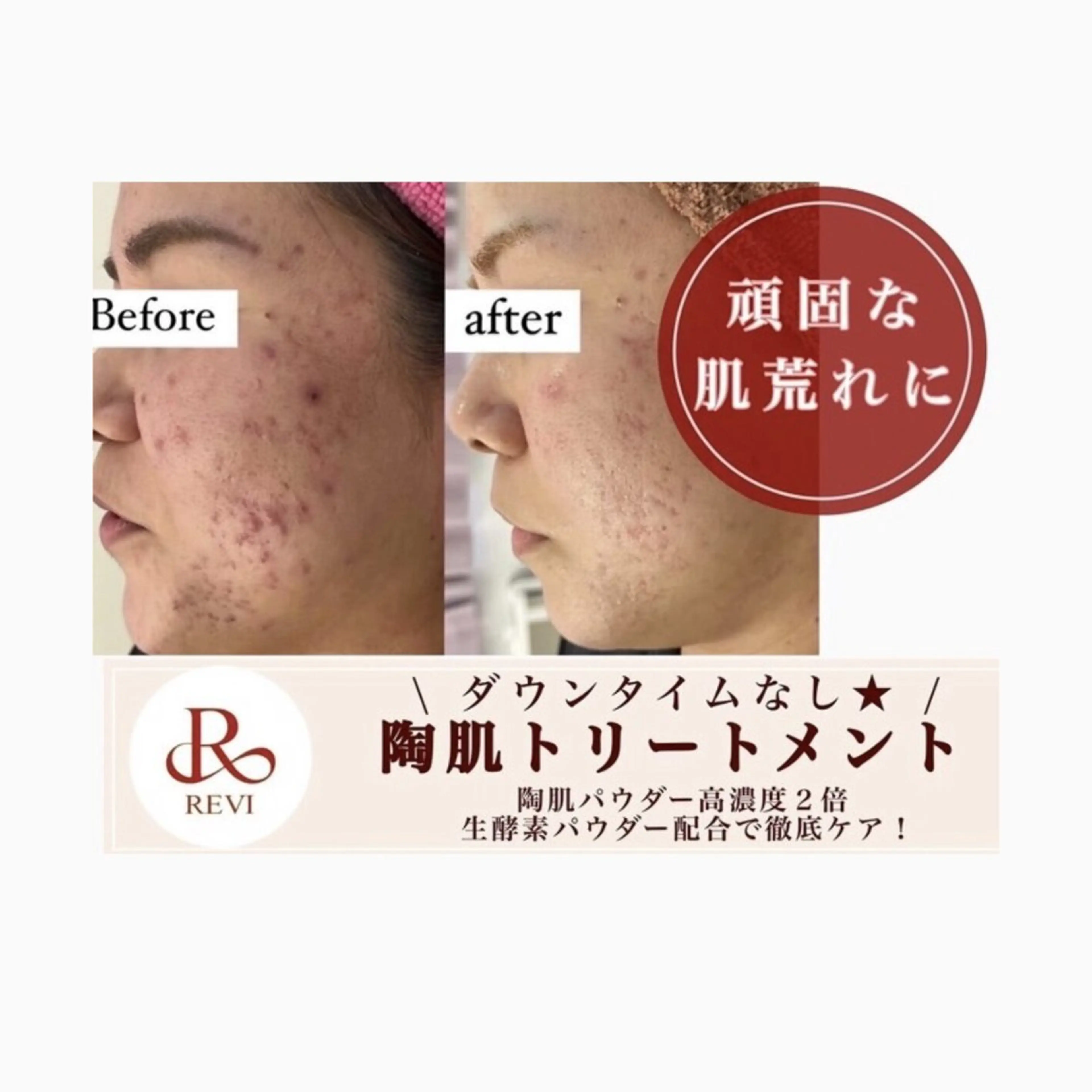 🌿REVIハーブピーリング🌿➕生酵素パウダー1gの写真