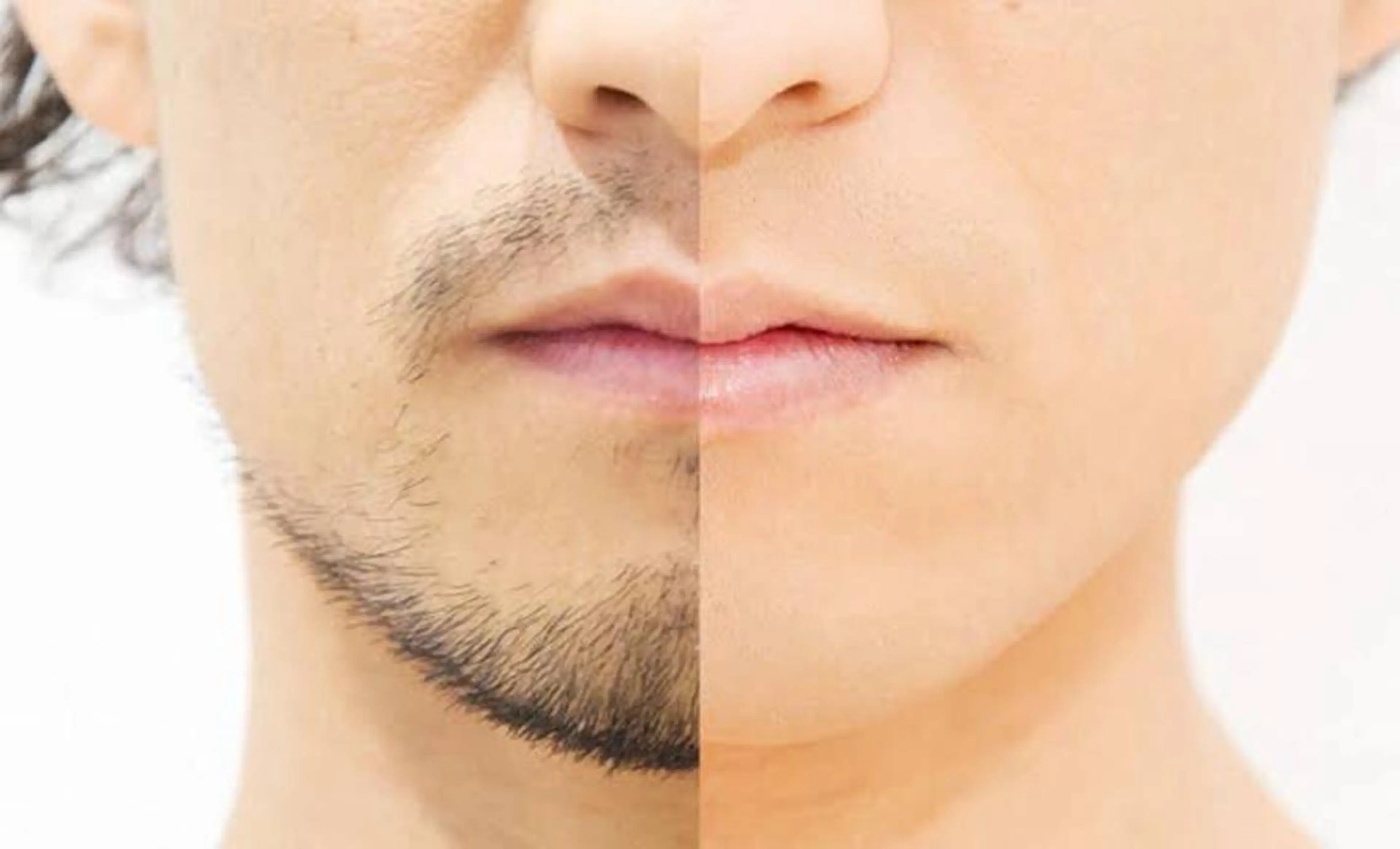 【メンズ限定】ヒゲ脱毛🥸の写真