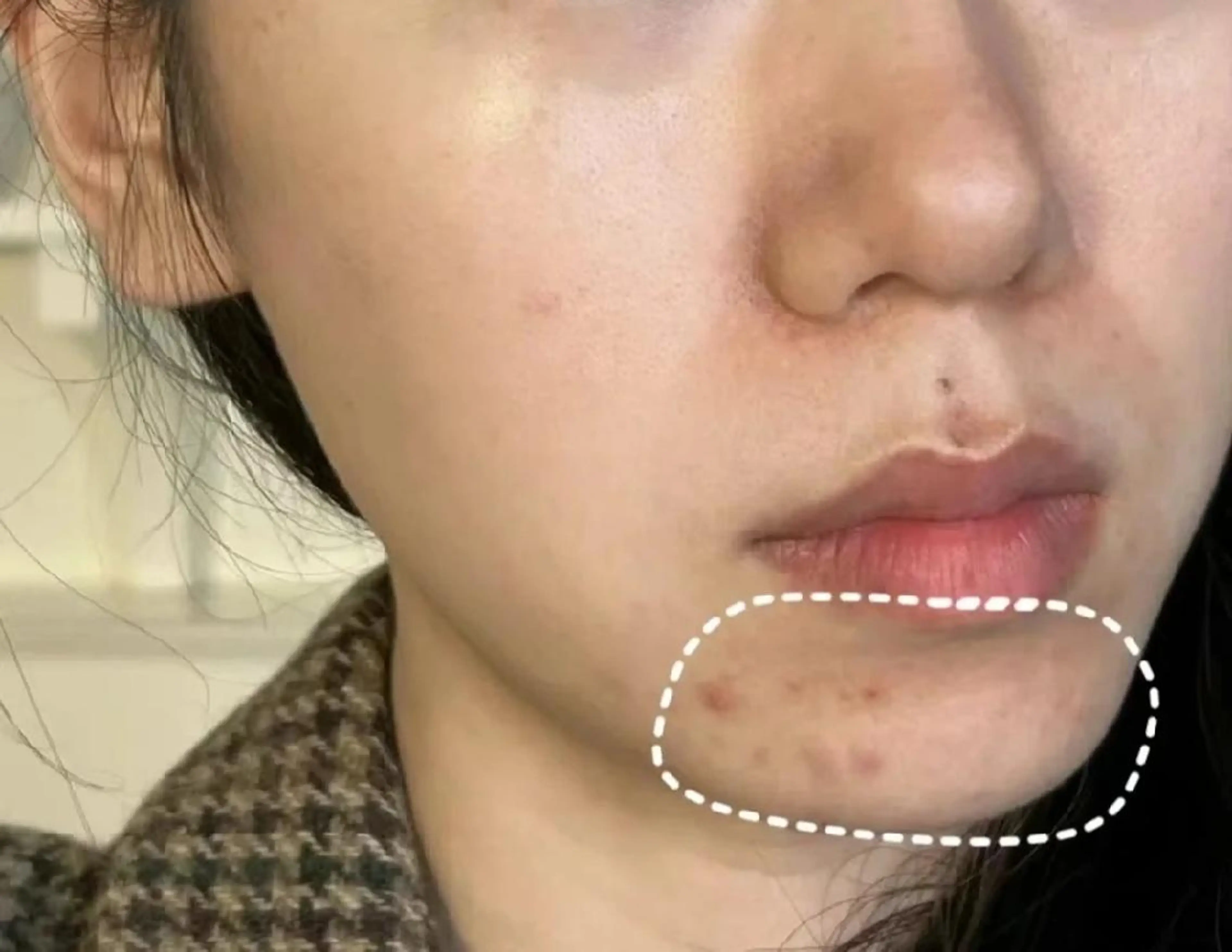 脱毛 aliaハイフ&水光ジェットサロン所属・aliaハーブ水光店 エステティシャン募集のエステ・リラクイメージ