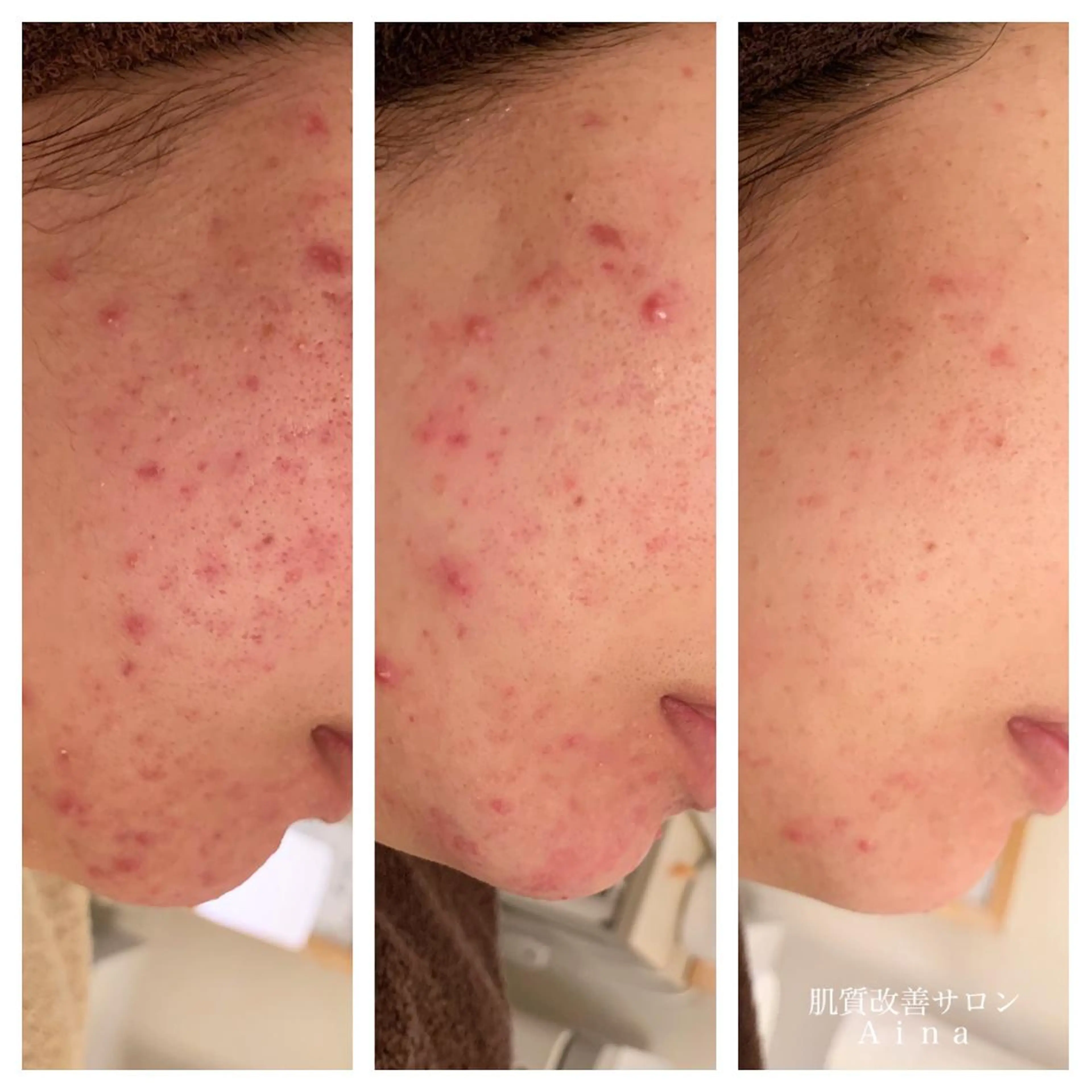 ロング カラー パーマ ヘアアレンジ メンズ キッズ ネイル マツエク・マツパ エステ リラク ニキビ跡専門サロン Ainaのエステ・リラクイメージ