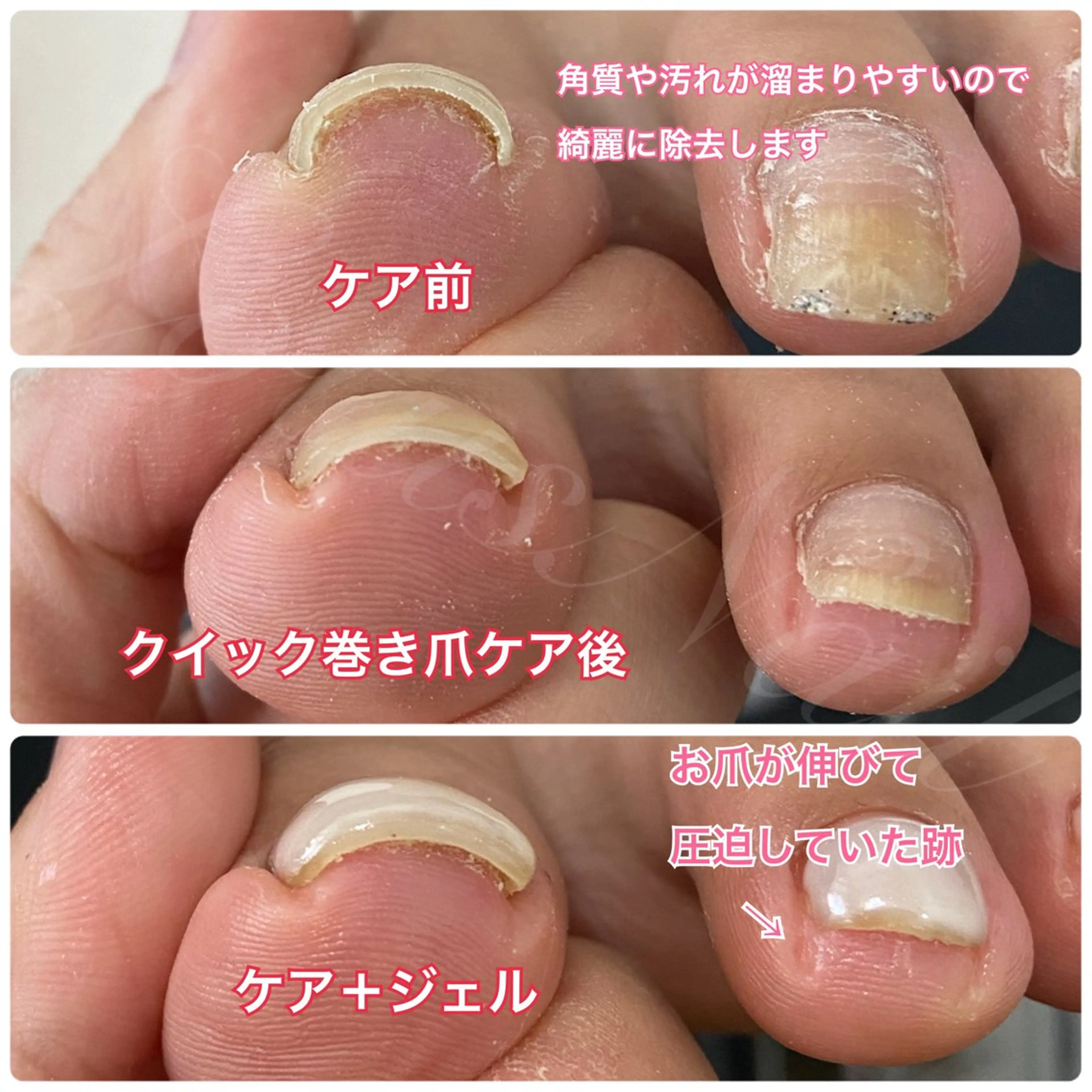 巻き爪ケア＋Footワンカラー⚠️注意事項をお読みいただきご理解の上ご予約ください。の写真