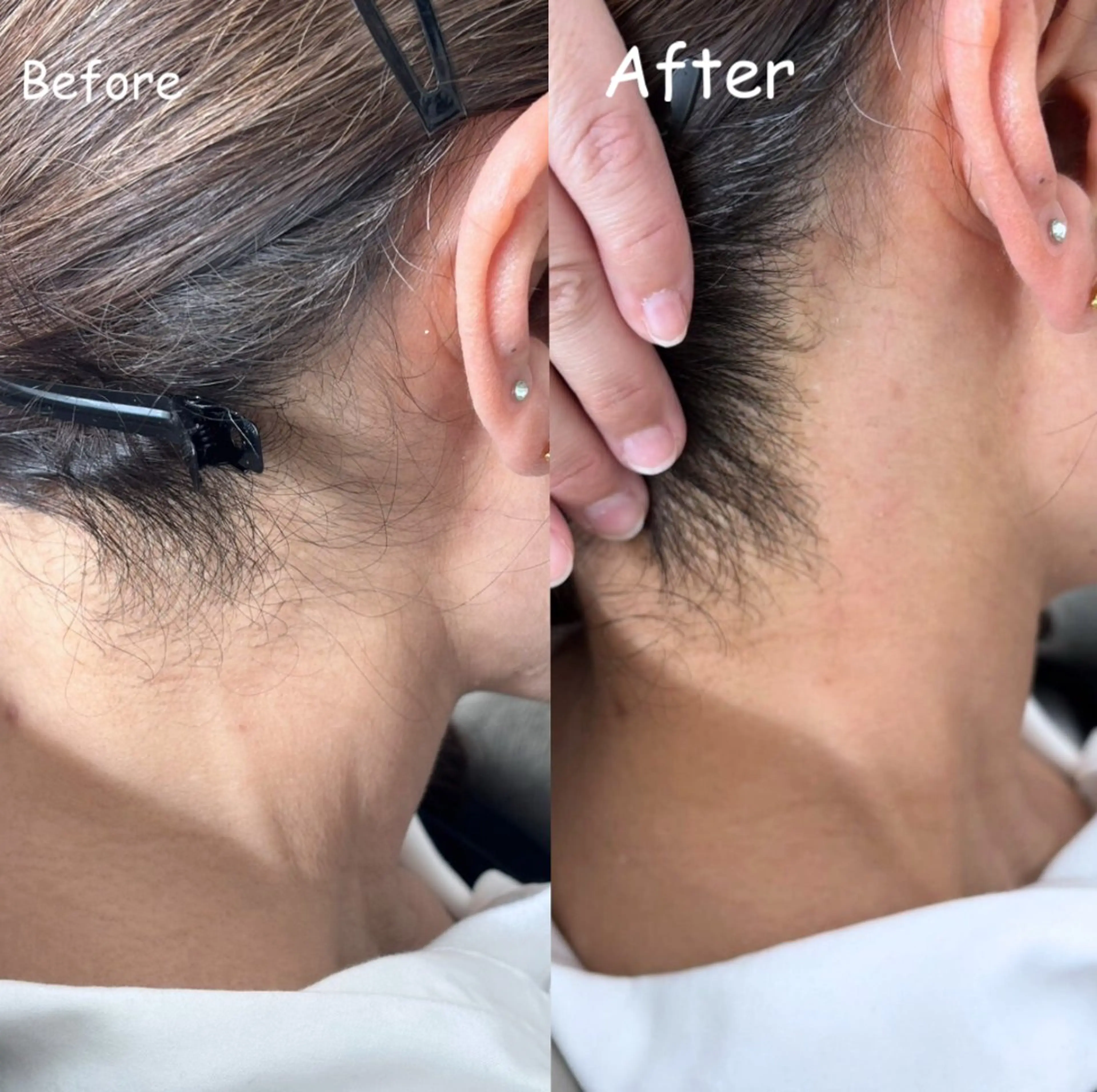 (女性)4,500円→4,000円 うなじWAX脱毛の写真