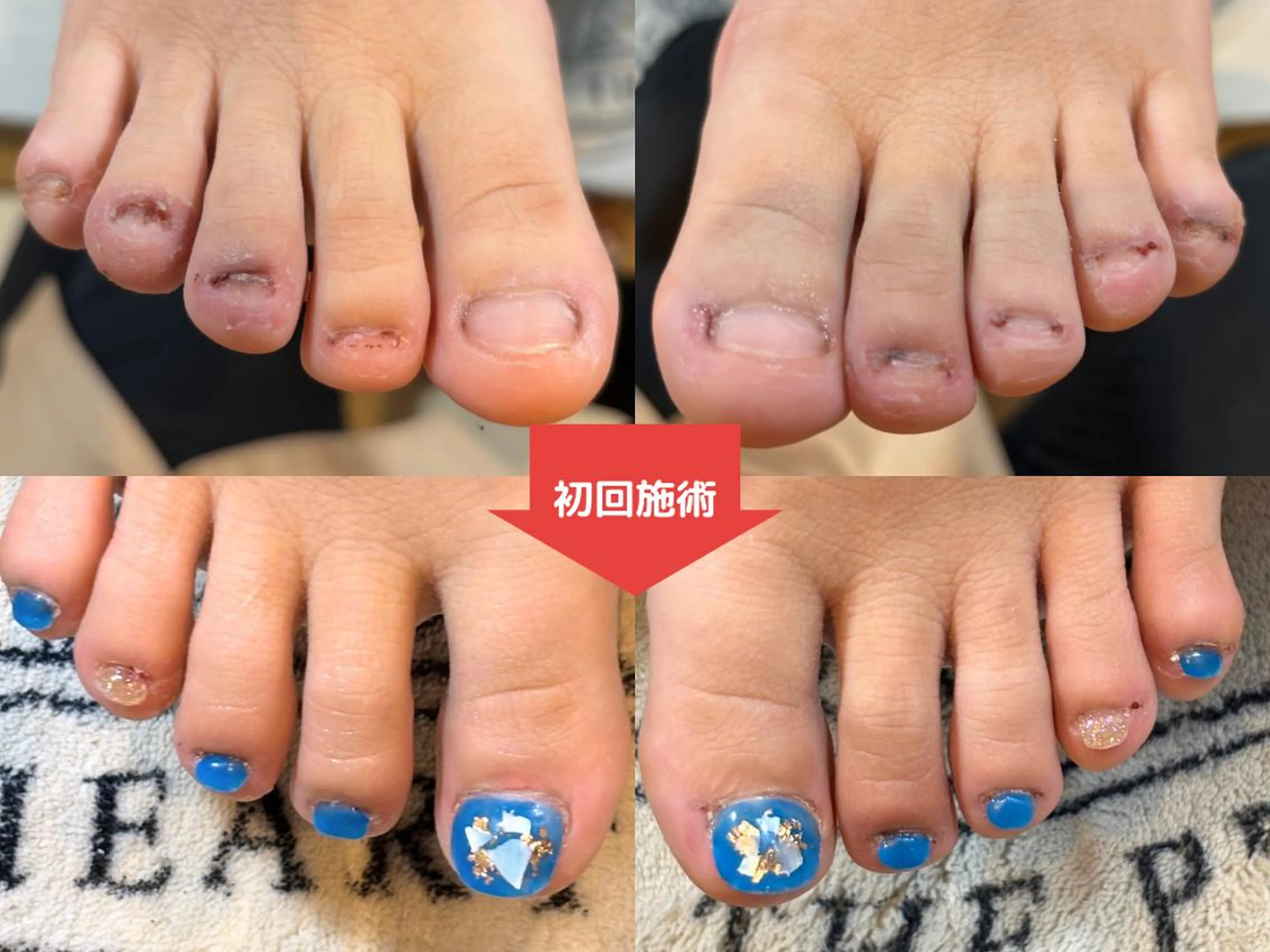 ネイル 深爪矯正・自爪育成 ネイルサロンアモまいのネイルデザイン