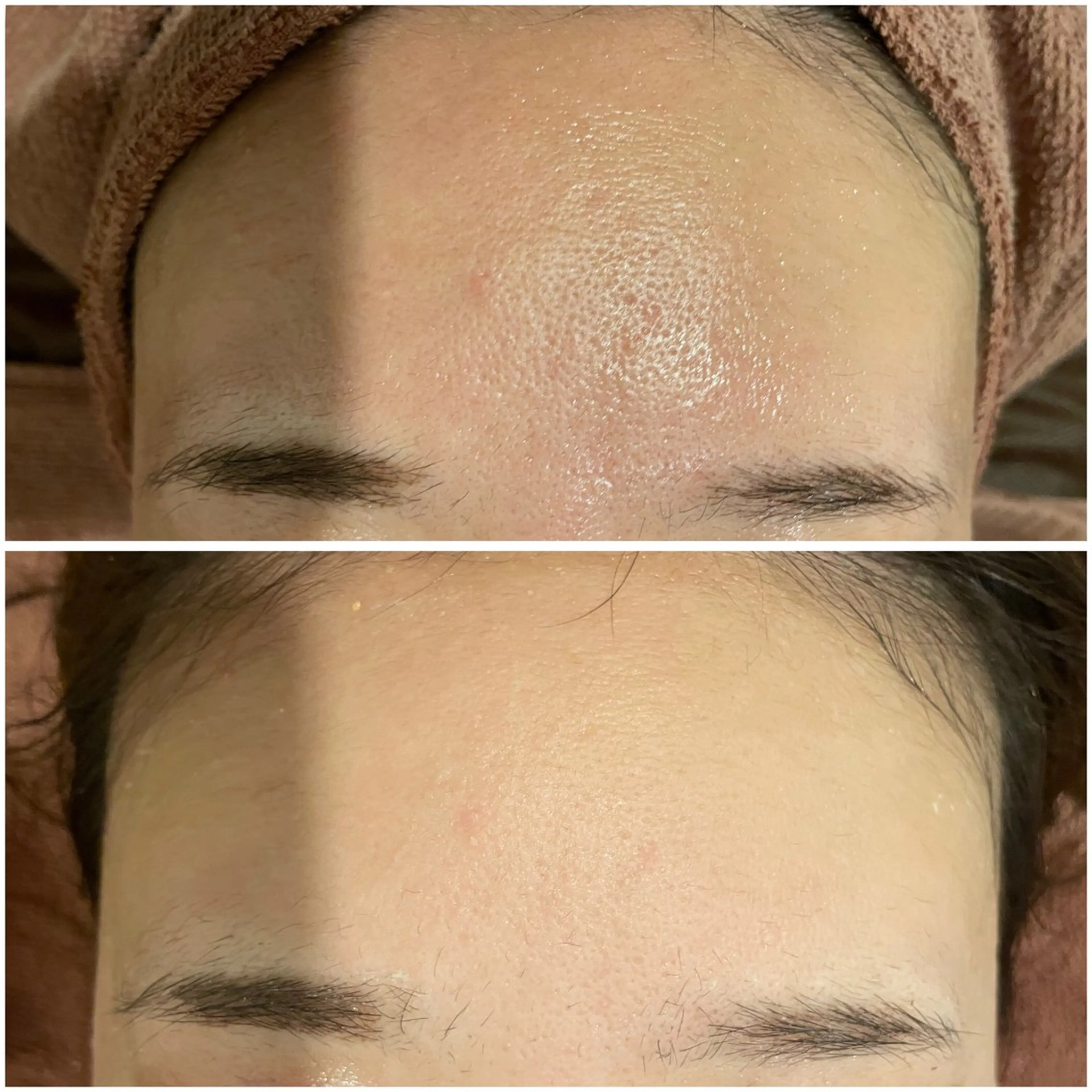 ニキビ特化型エステ 🍓最短で肌質改善のその他イメージ