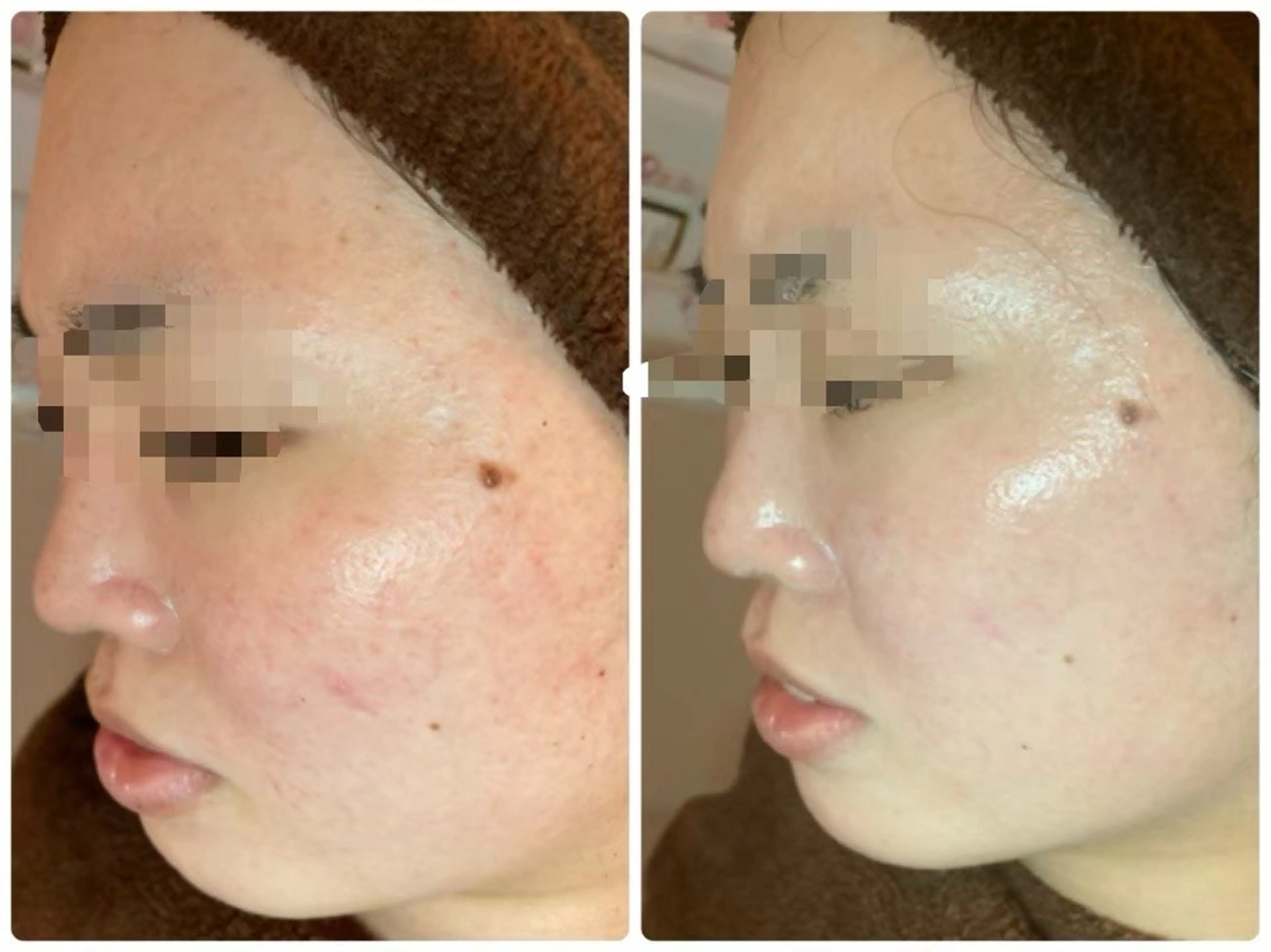 ニキビ･毛穴悩み特化 /CHISATOのエステ・リラクイメージ