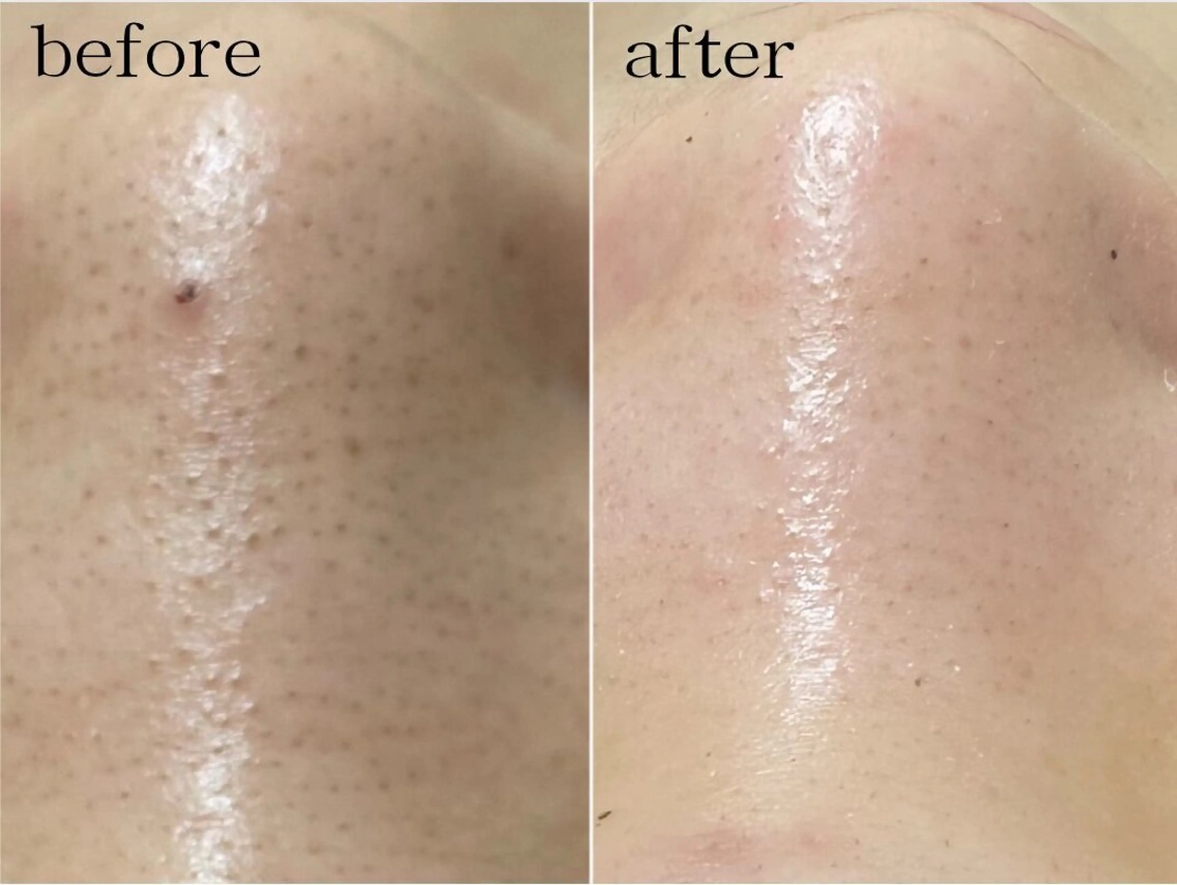 【20代人気No.1】初回限定！　鏡の近距離、もう怖くない。黒ずみ毛穴を本気でなんとかしたい人へ！の写真