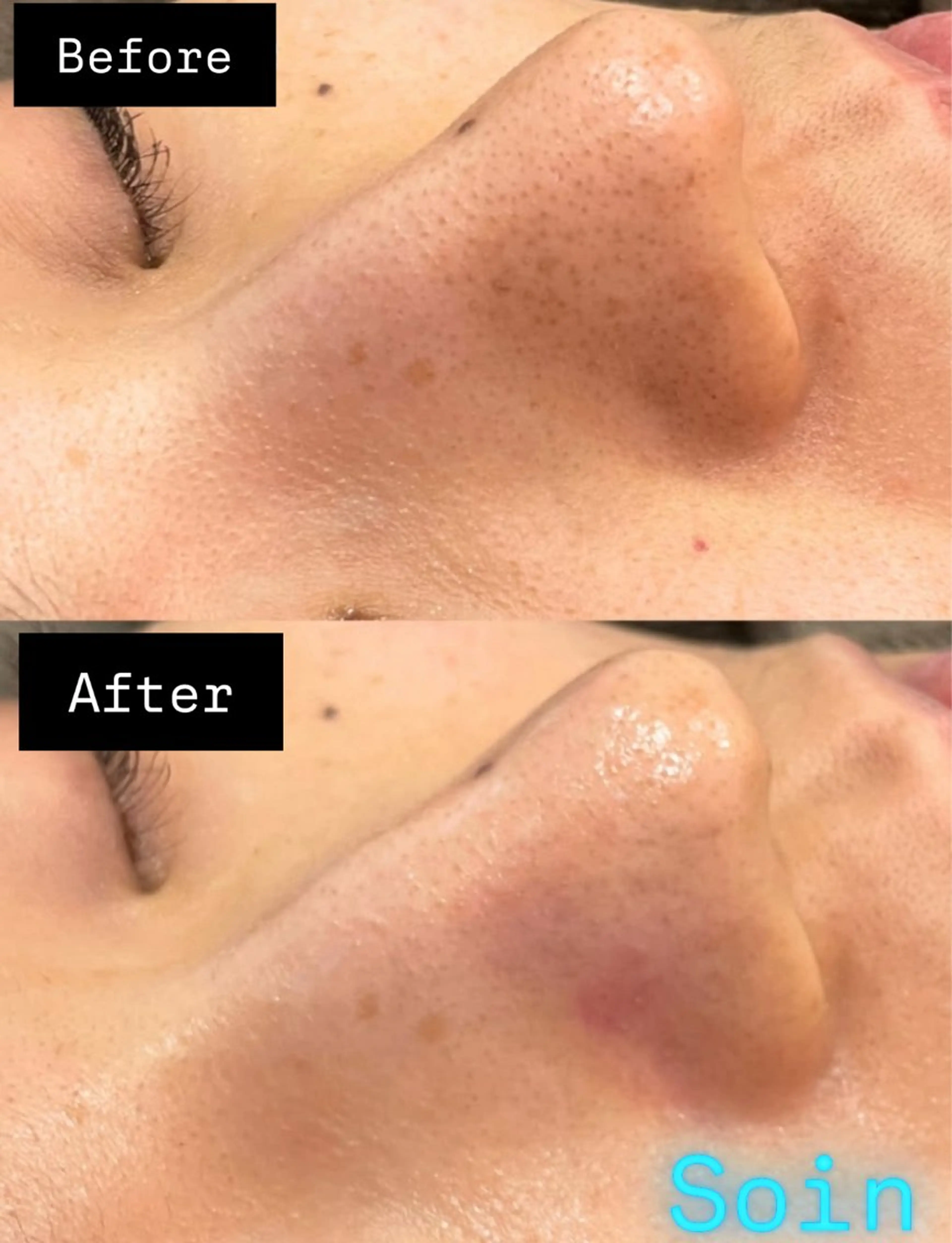 ハイドラ毛穴洗浄/レチノールモデリングパック付き¥8,000→¥7,000の写真