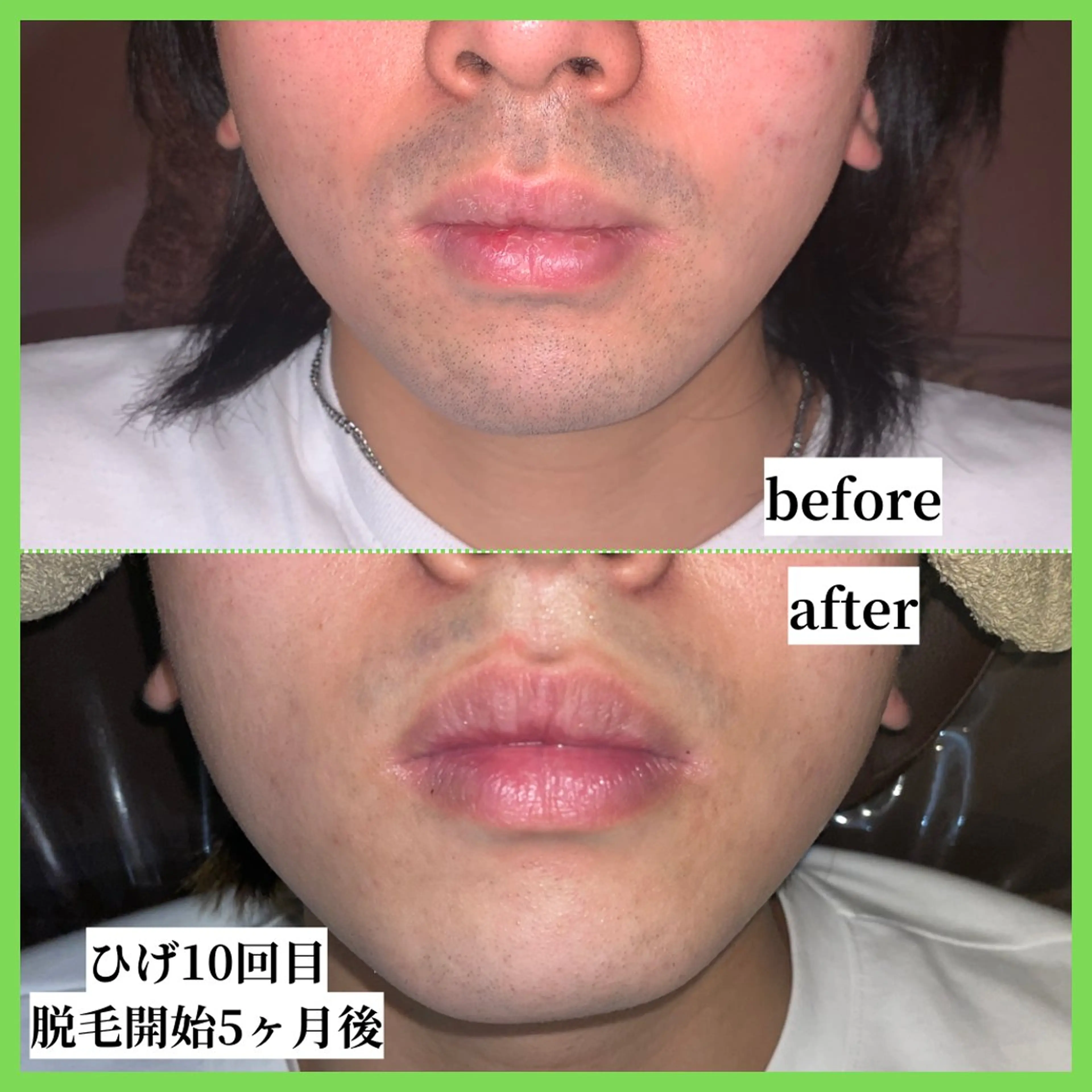 メンズ 脱毛 天神【効果重視脱毛】 YouMakeのエステ・リラクイメージ