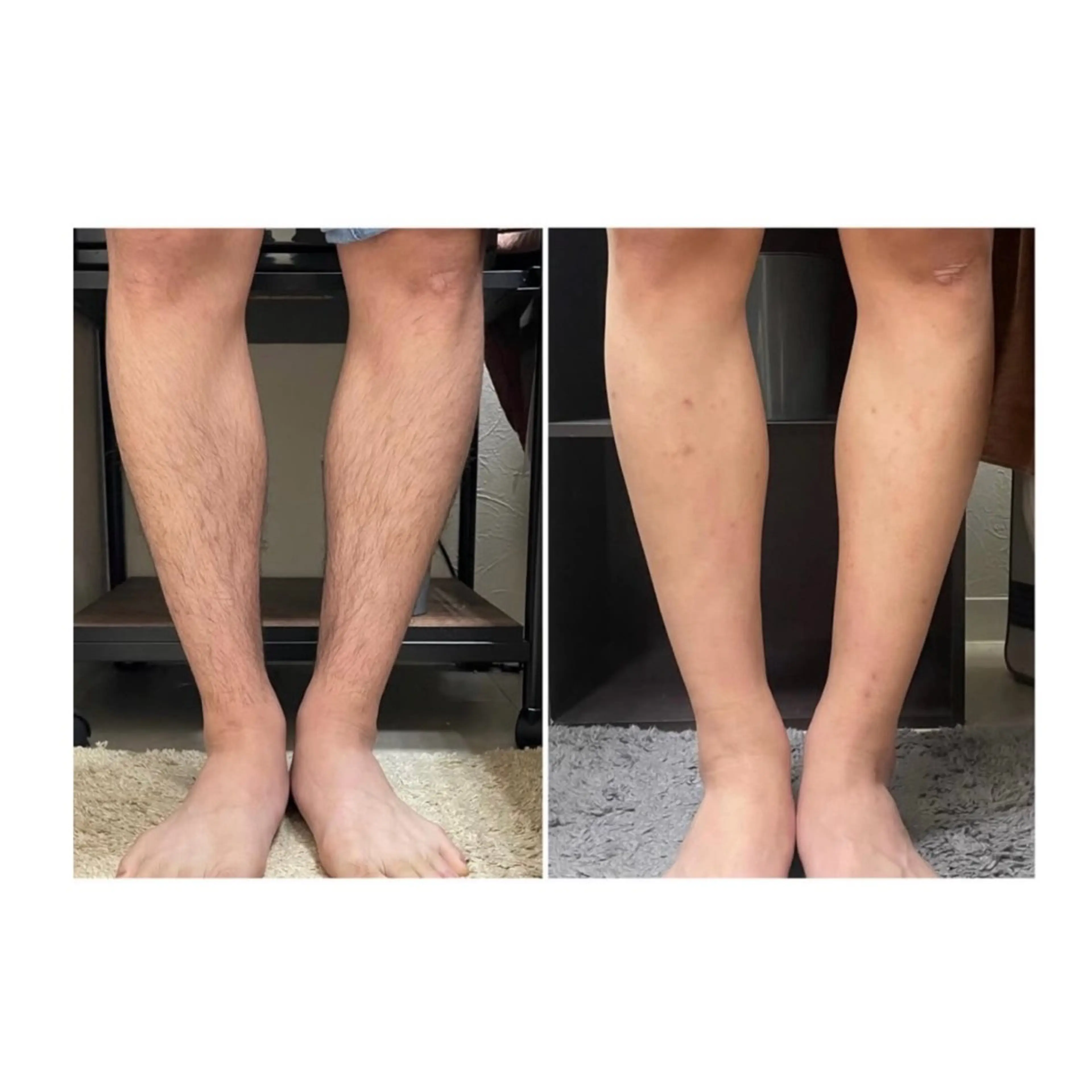 メンズ👦🏻脚全体脱毛※無料シェービング付の写真