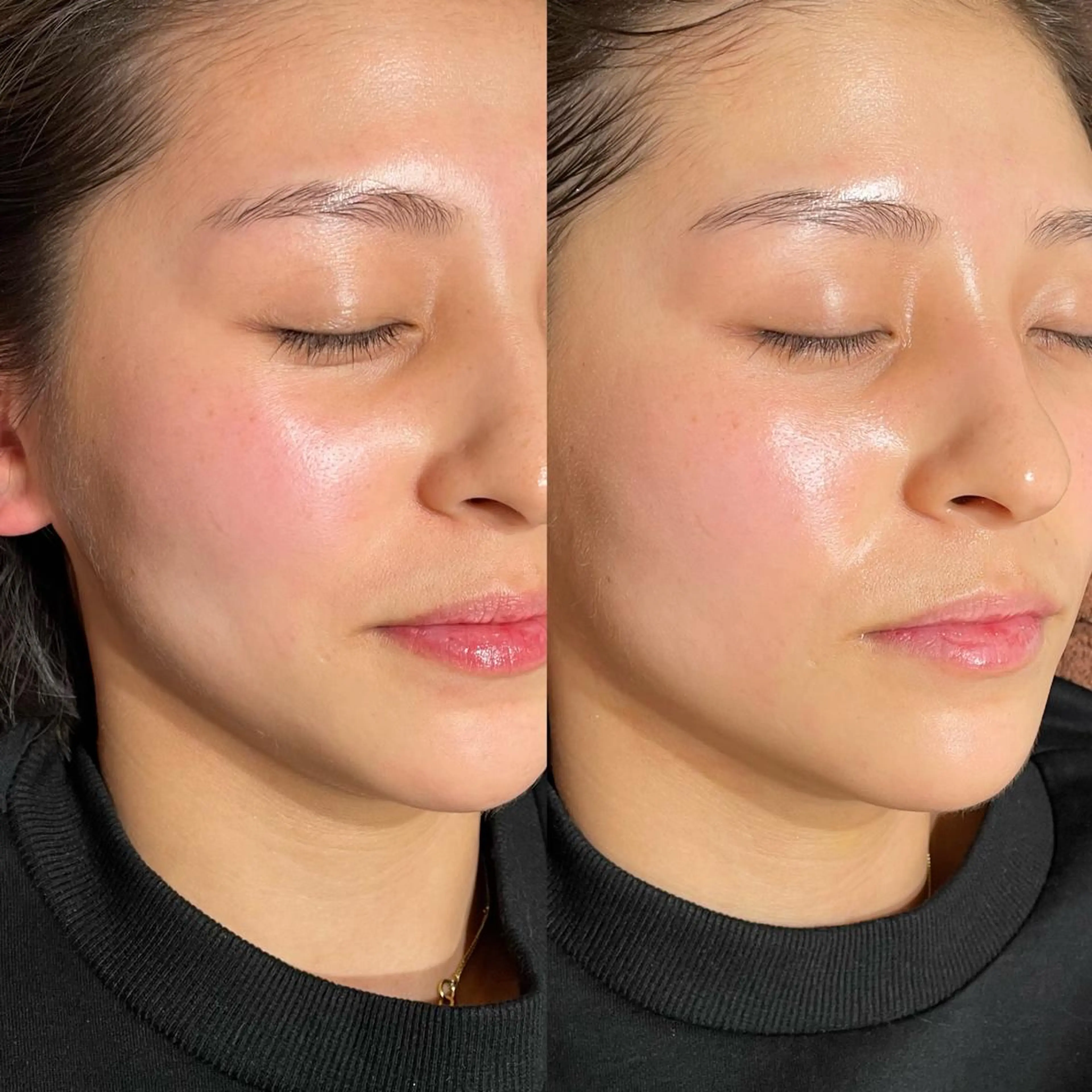 mieux所属・ハーブピーリング ¥6600のエステ・リラクイメージ