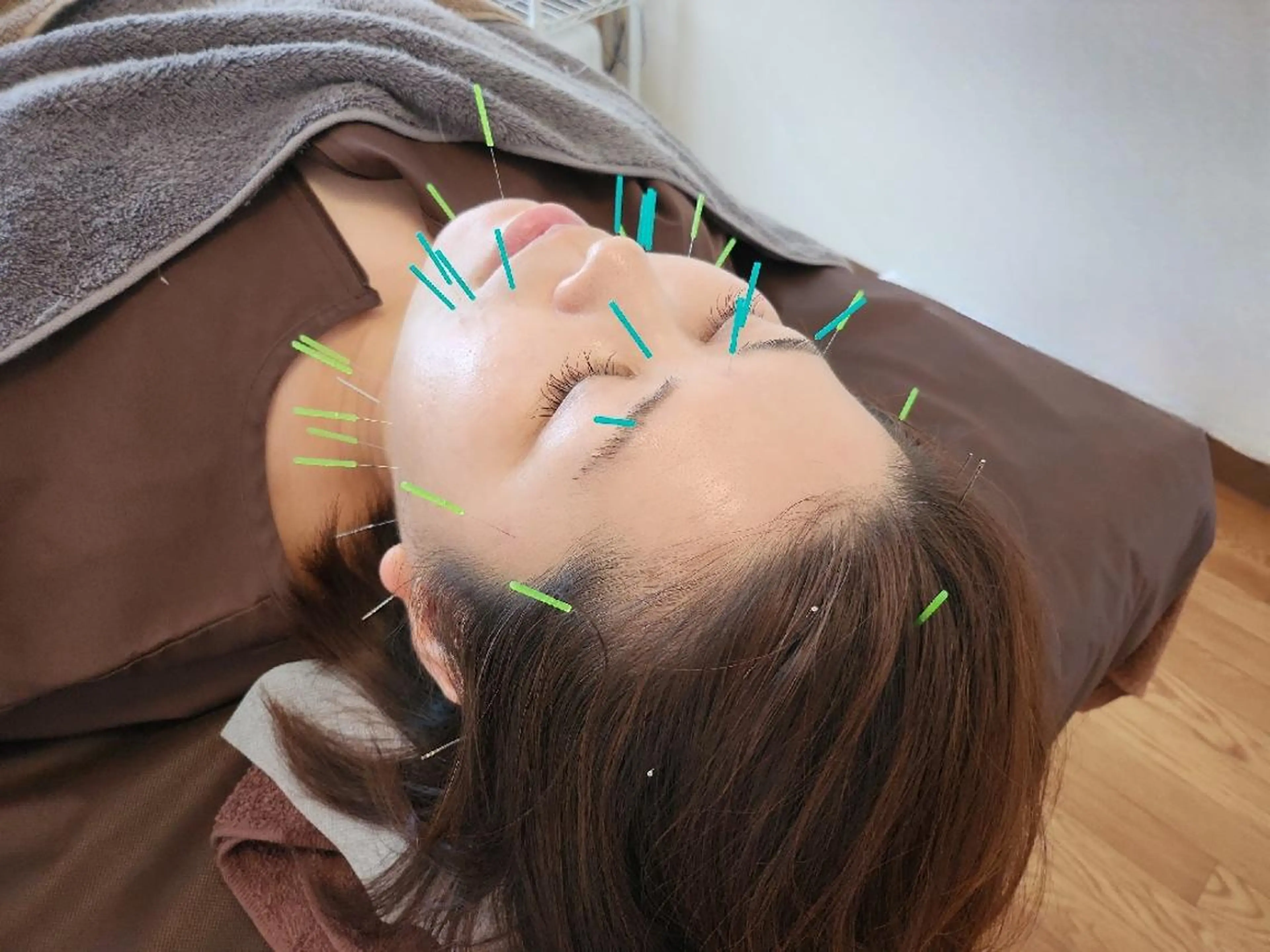 エステ リラク 即効⚡小顔美容鍼🪡 むくみたるみ脂肪解消のエステ・リラクイメージ