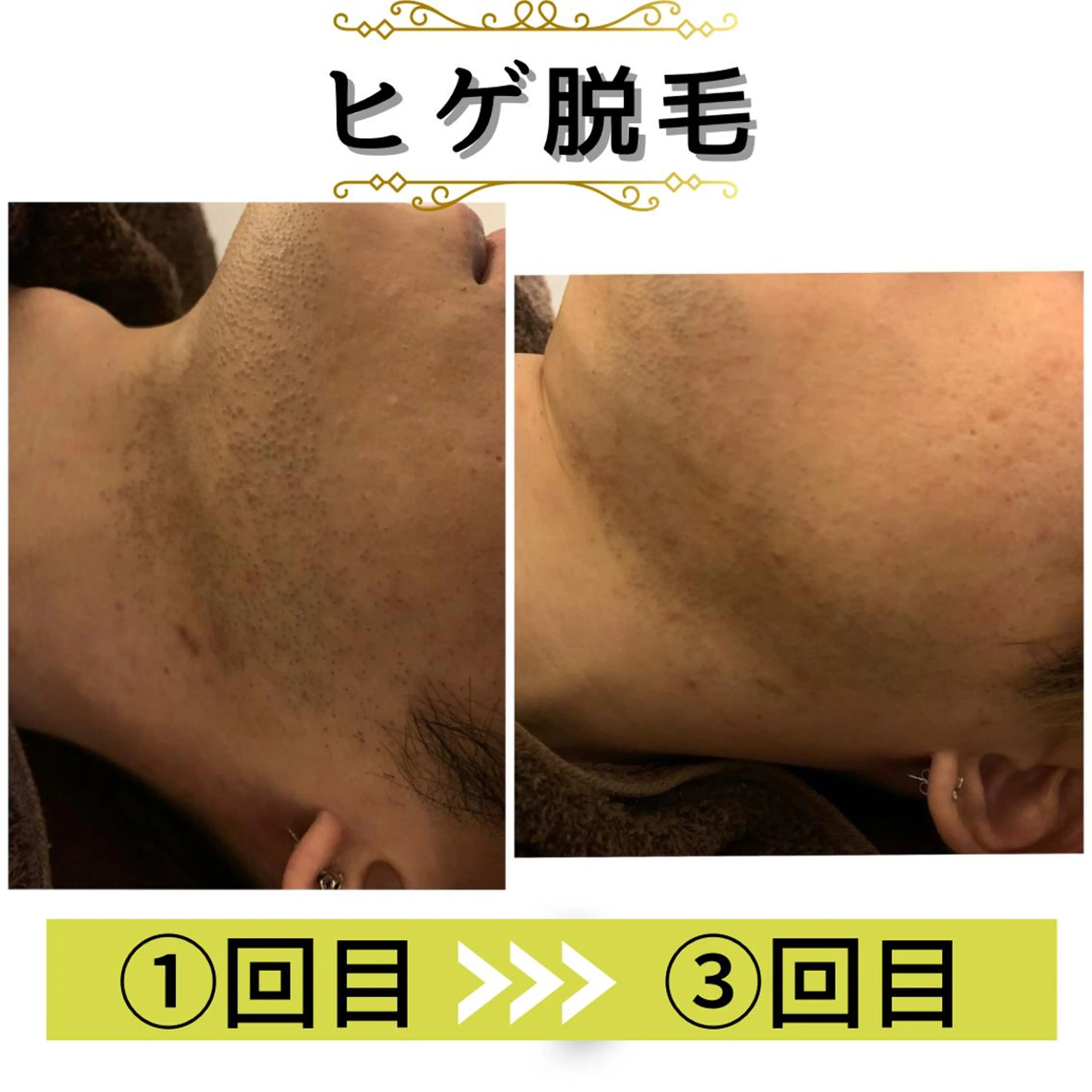 メンズ メンズ脱毛サロン 髭職人VIO(ヴィオ)所属・サロンVio梅田店 平山のエステ・リラクイメージ