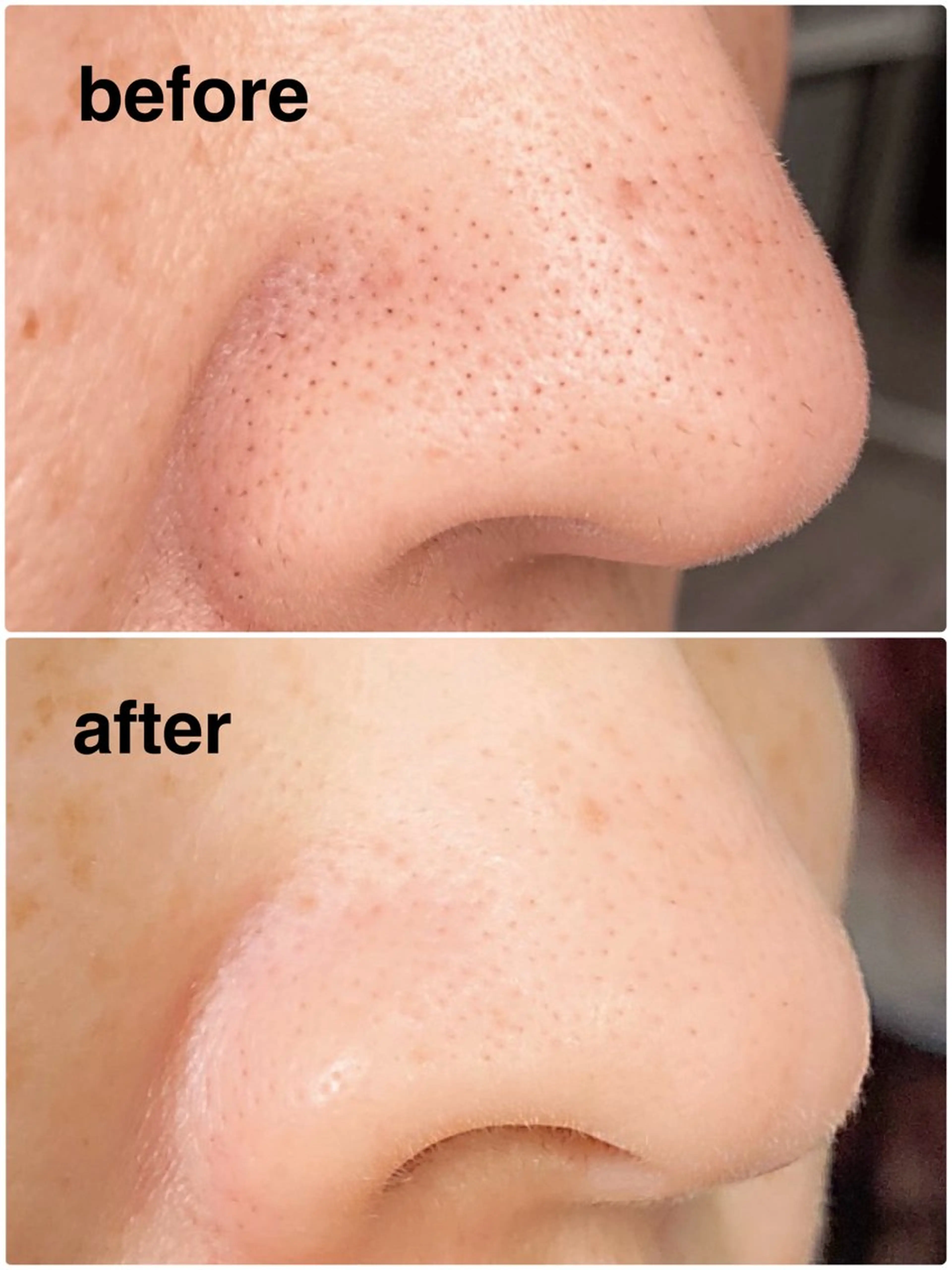 『新規様限定！！佐賀県1格安』韓国大人気ララピール＋グローパック✨￥12,000→￥9,800の写真