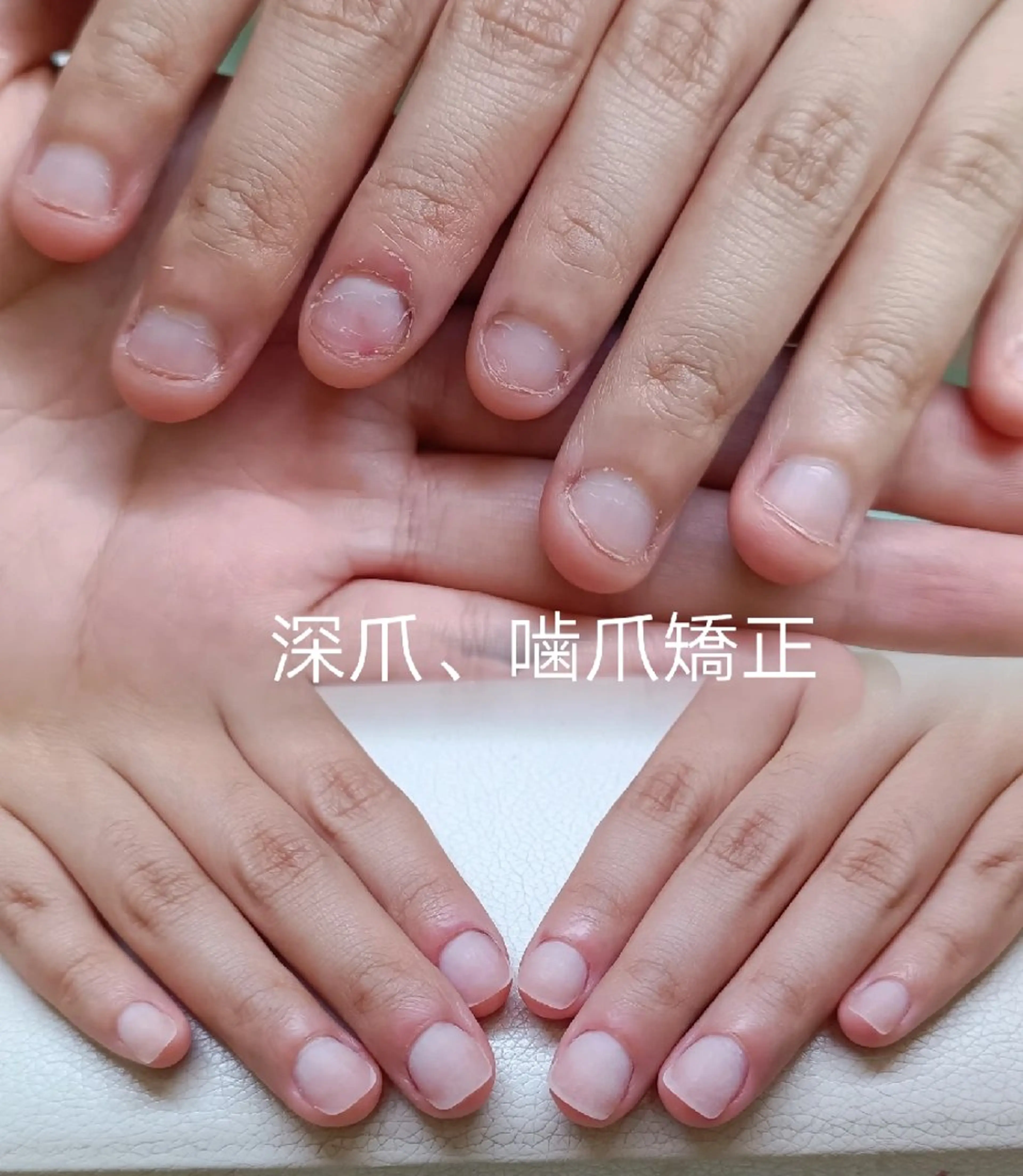 ネイル ハンドネイル ネイリストゆか💅 長さだし、深爪矯正のネイルデザイン