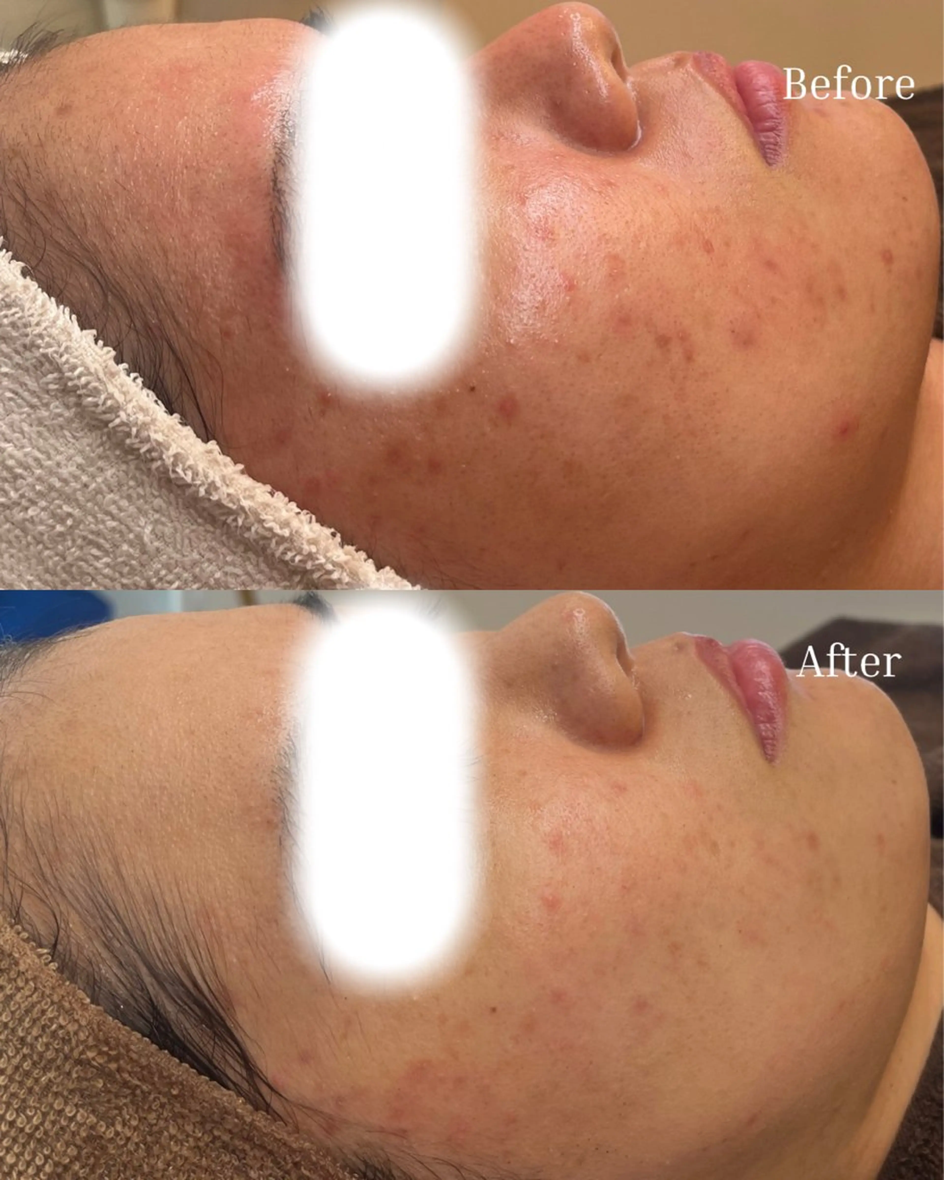 エステ BELLIS HUIT所属・ハーブピーリング那覇 BELLISHUITのエステ・リラクイメージ