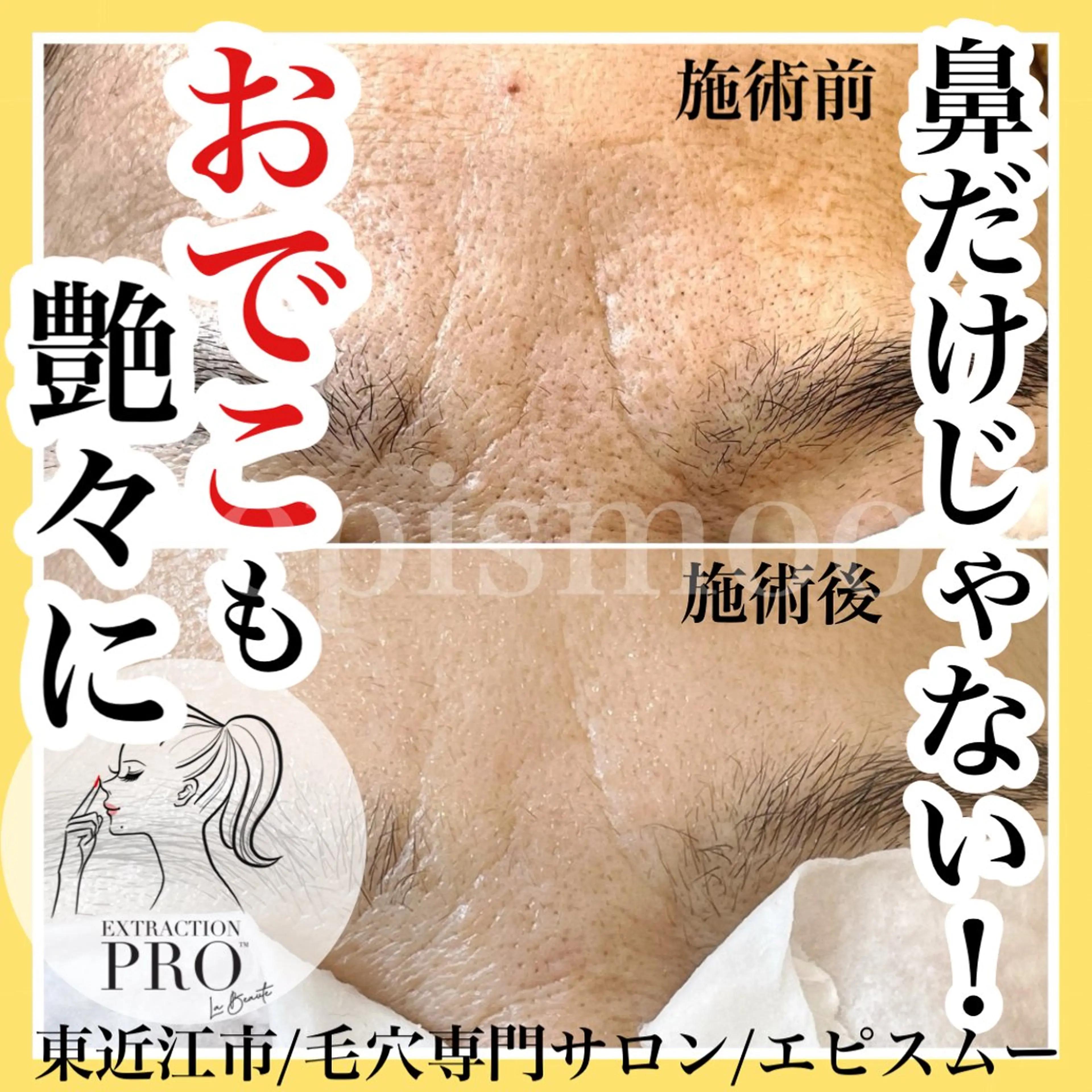 epismoo 脱毛/HBL/毛穴の眉毛・アイブロウイメージ