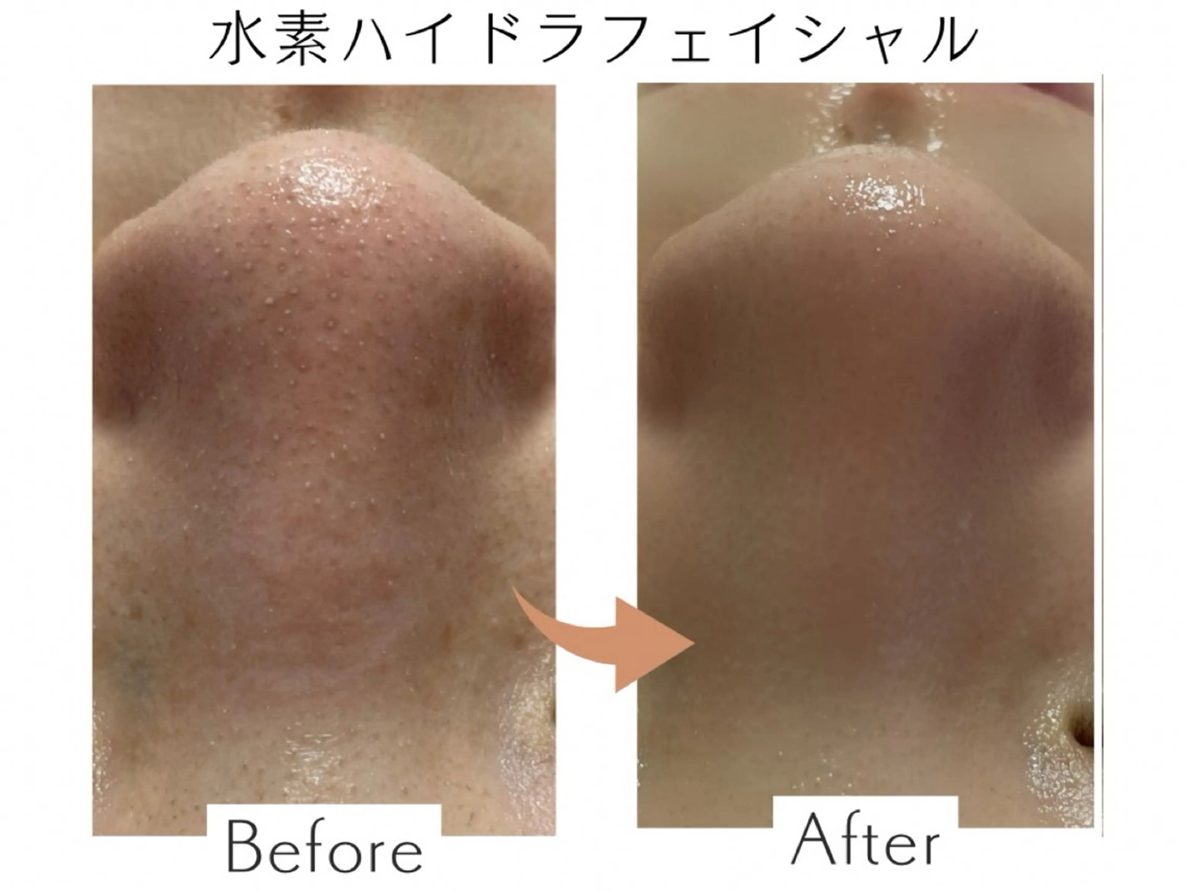 【リピート】水素ハイドラフェイシャル✨の写真