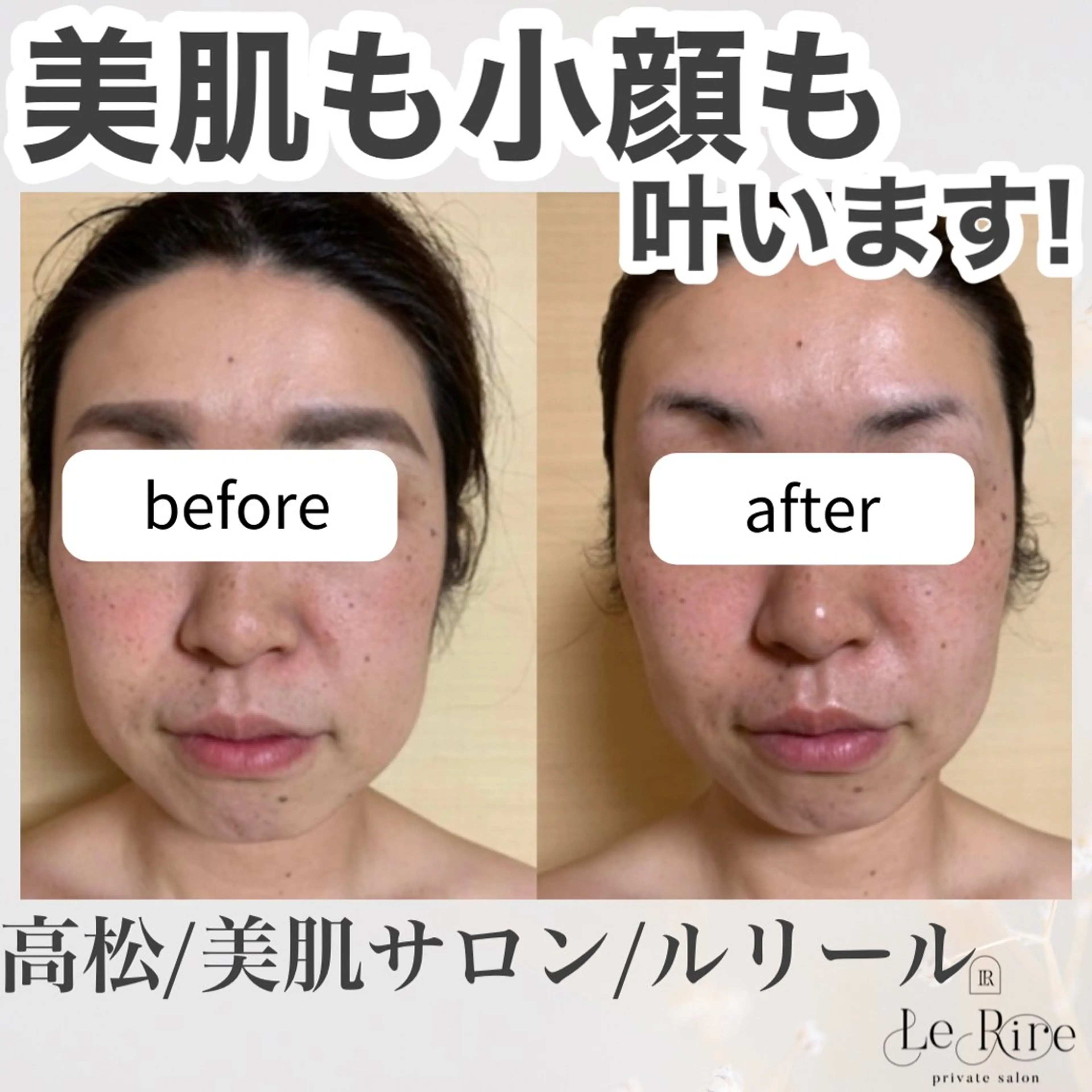 Le Rire式痛くない小顔矯正の写真