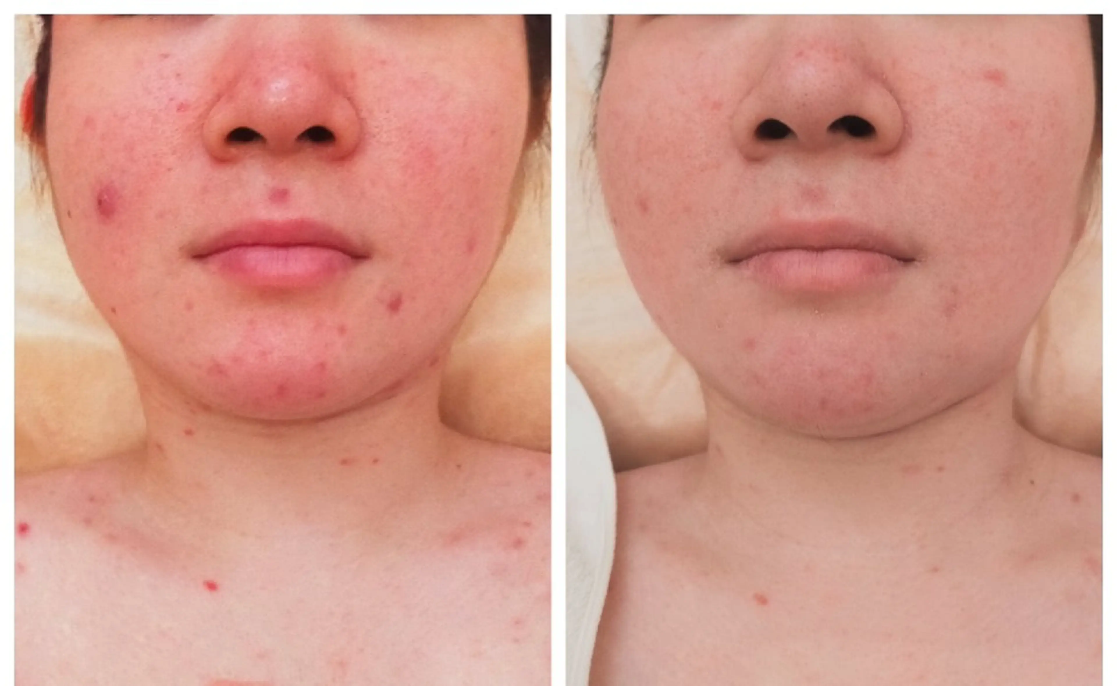 【初回お試し】なめらか肌に変身!ニキビ肌ケア フェイシャルの写真