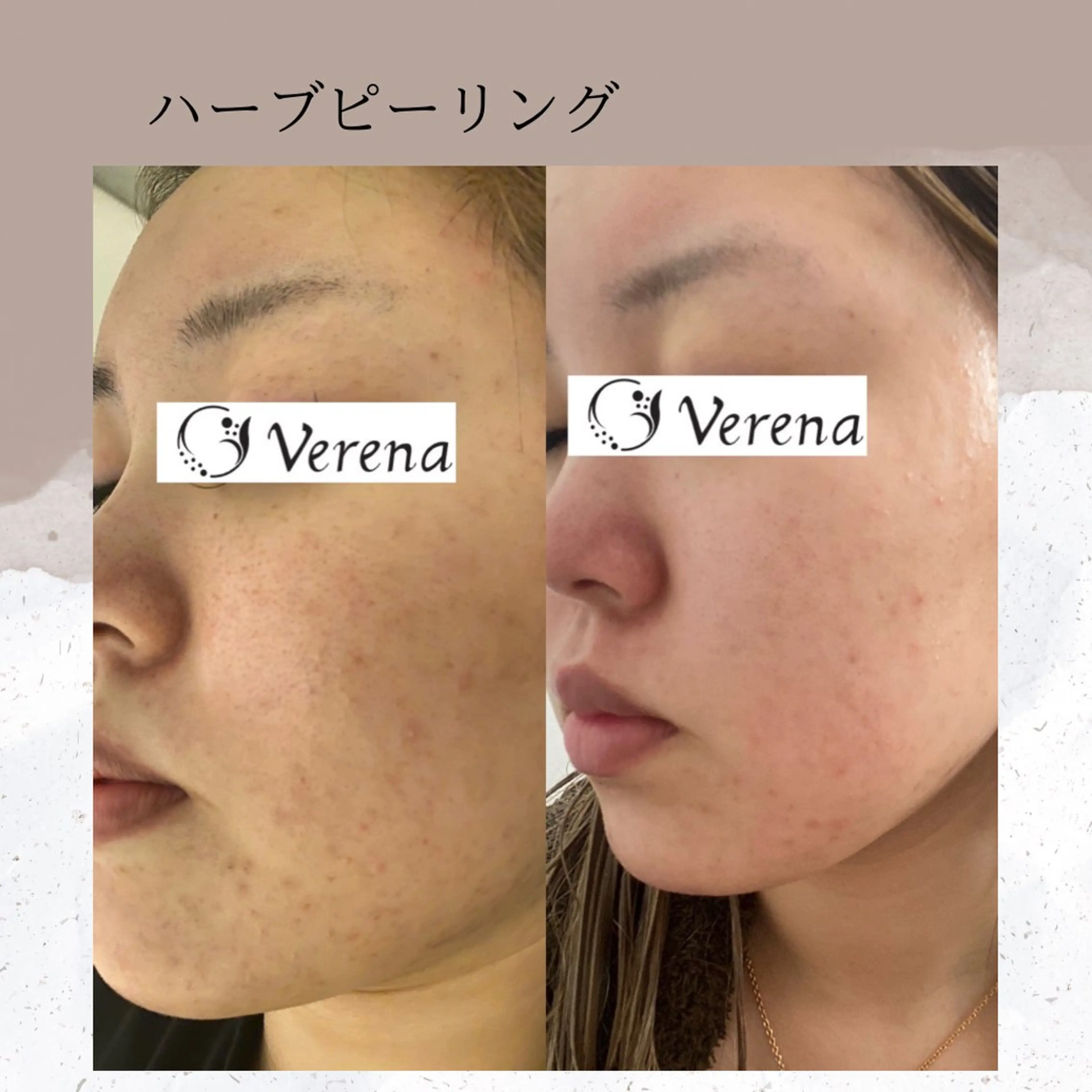 ピーリング専門店 Belluteのエステ・リラクイメージ