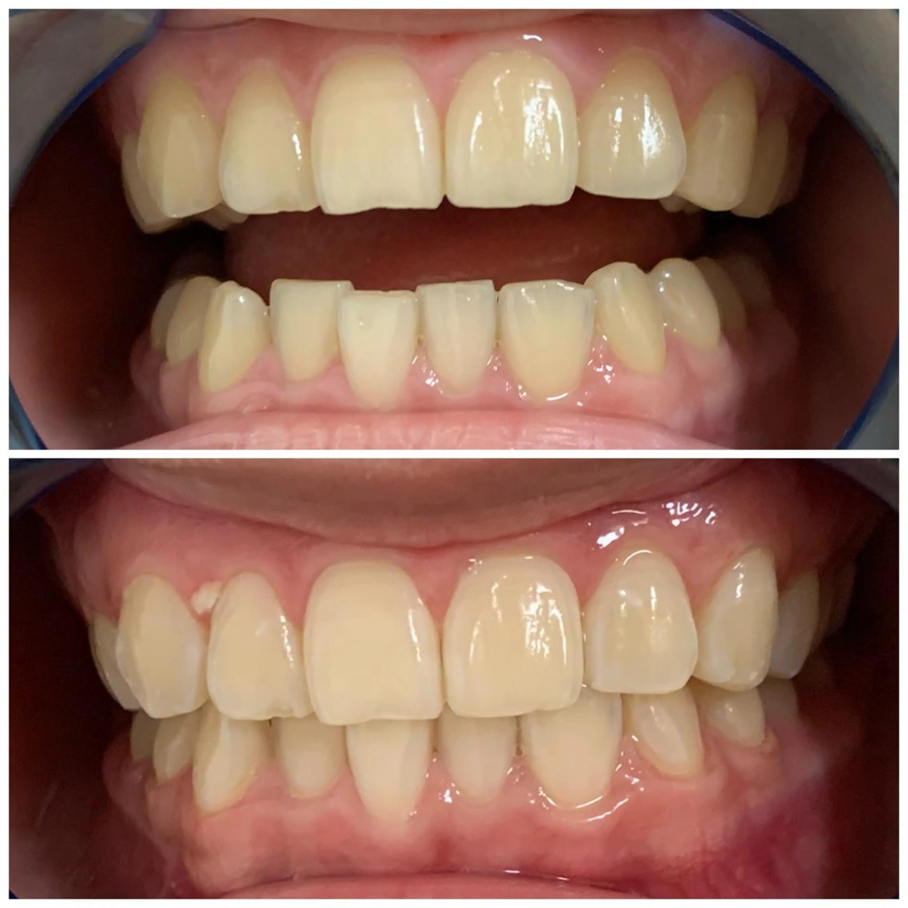 ホワイトニング🦷✨15分1回の写真