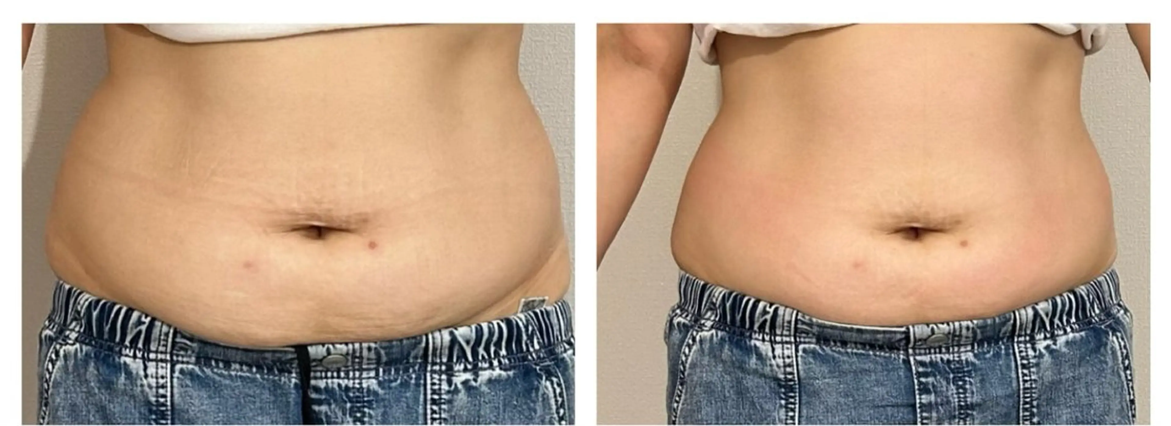 【毎月2名様‼️】本気で痩せたい方へ！結果重視！モニター価格にてプランが選べますの写真