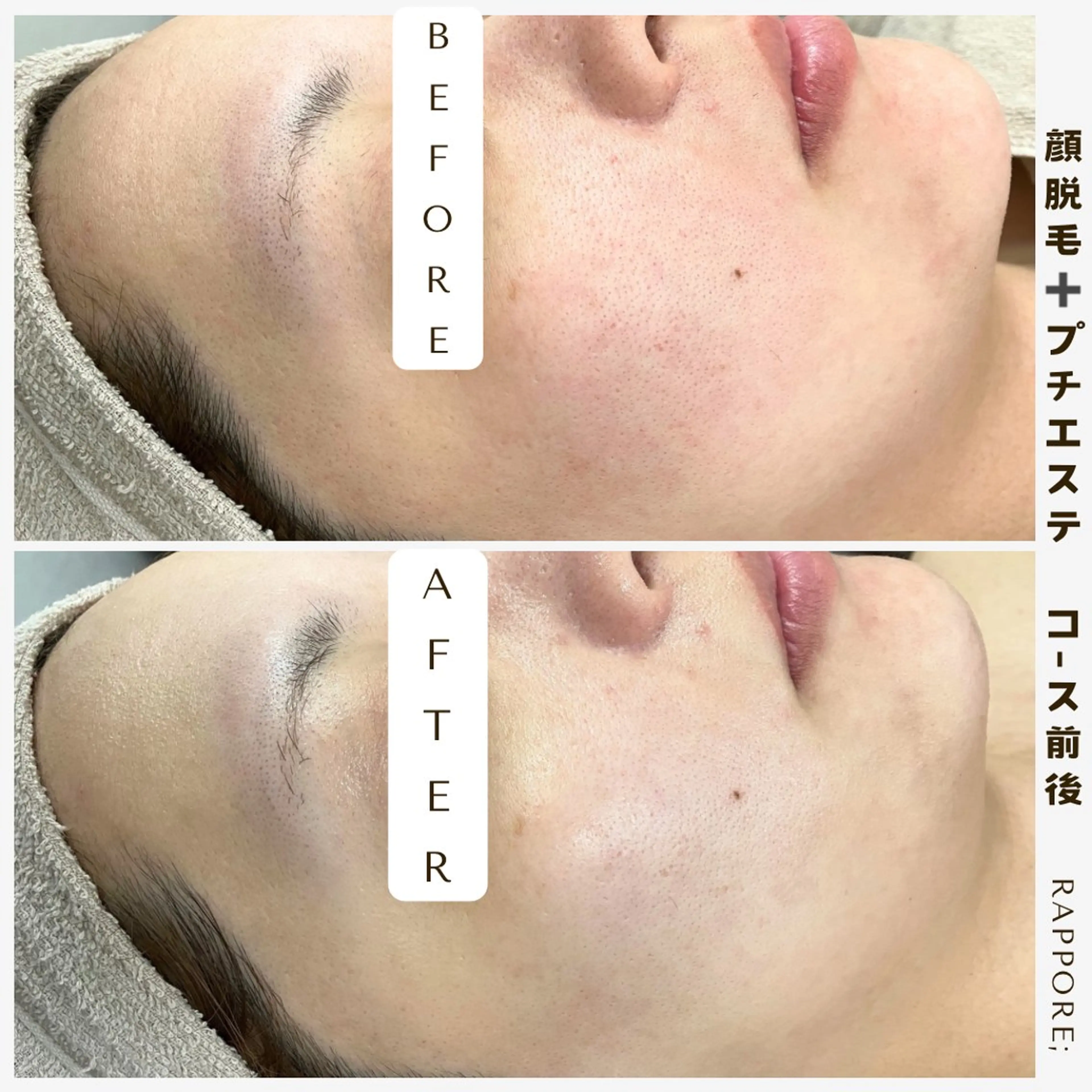 【毛穴引き締めも同時に叶う✨】レディース♡顔脱毛＋プチエステ付きの写真