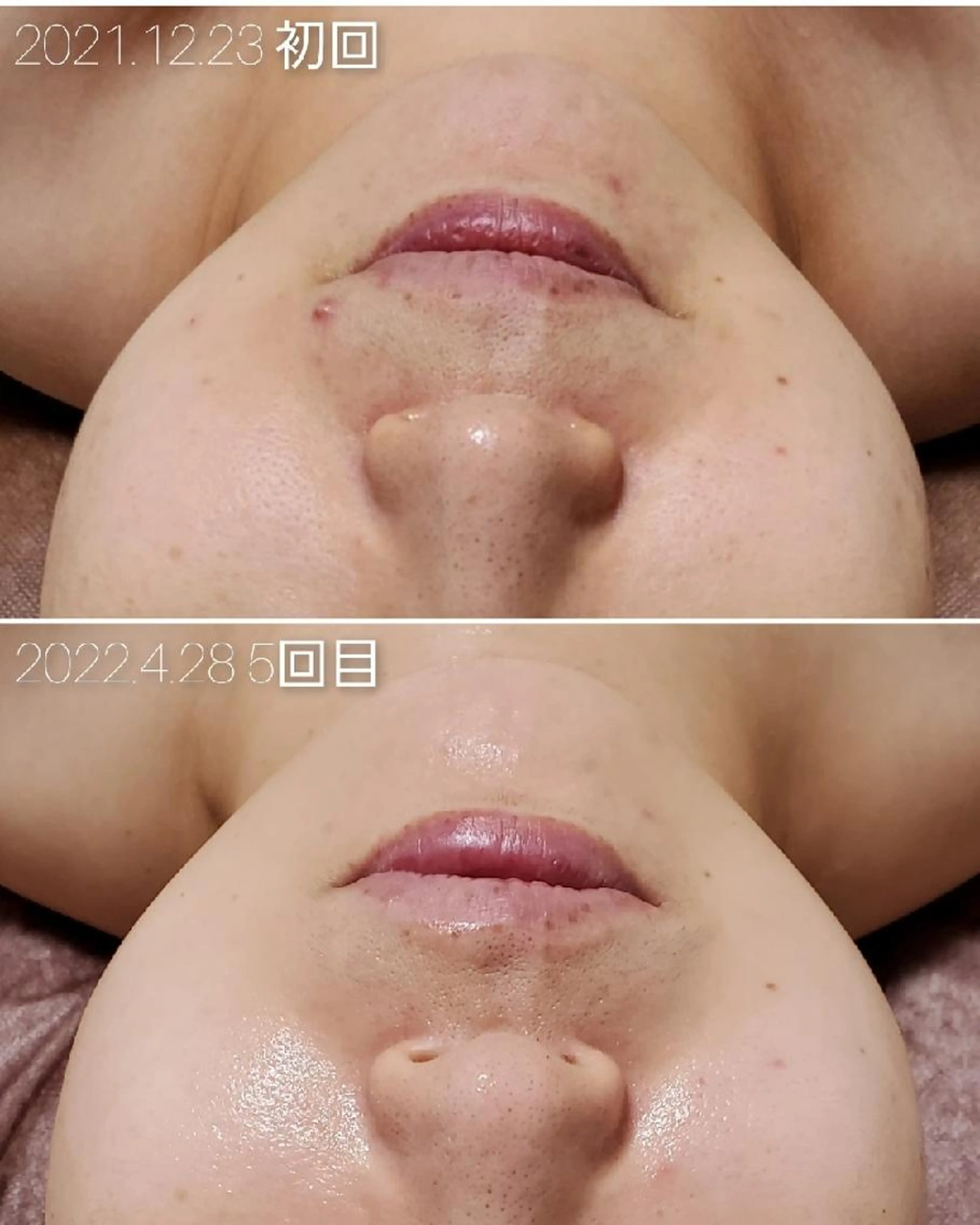 【肌育ケア】素肌革命★次世代型ハーブピーリング　～素肌を強く健やかに～の写真