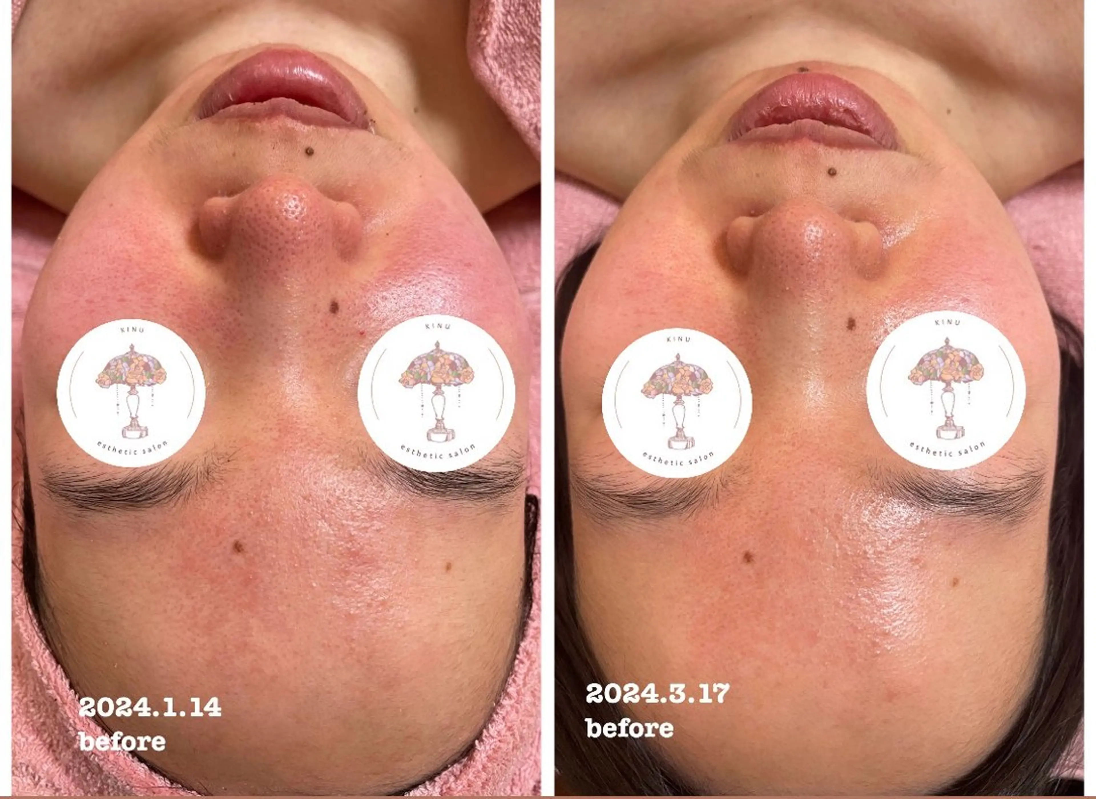 エステ 肌質改善専門店/絹々(きぬ)所属・心満たされる ハーブピーリング絹々のエステ・リラクイメージ