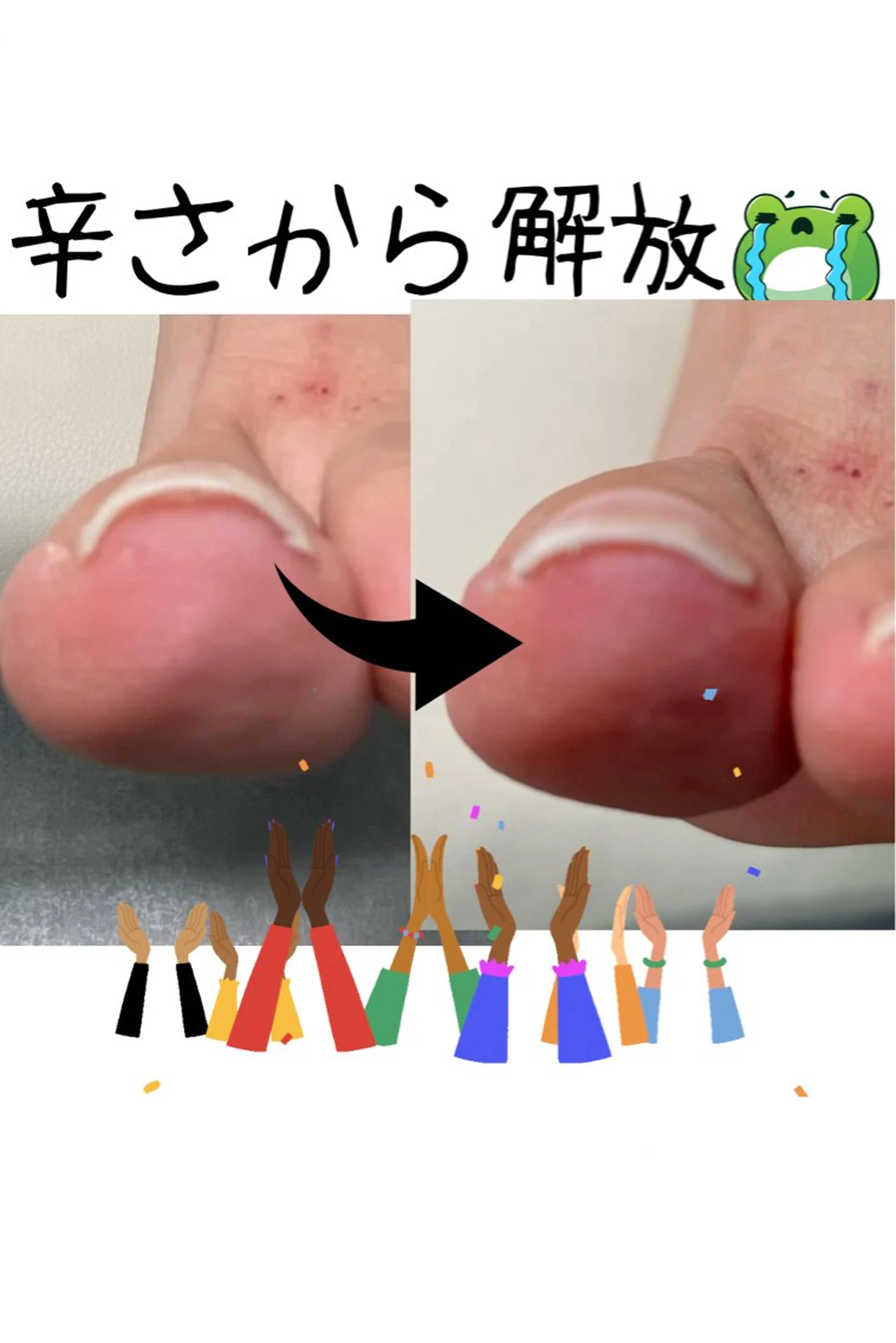 🍀巻き爪ケア🍀辛さから脱出✊の写真