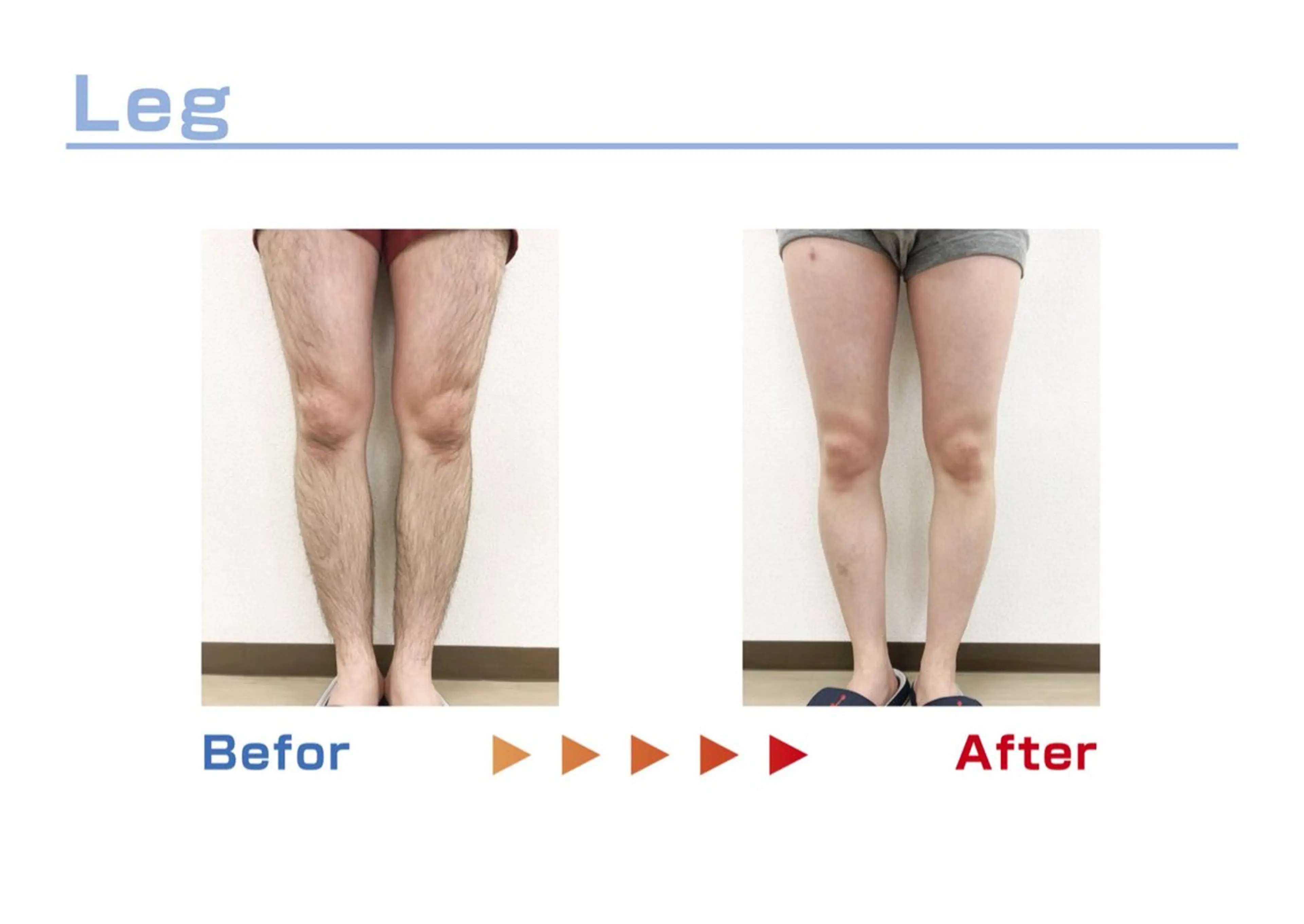 セルフ脱毛/美尻イス キングスサロン熊本のエステ・リラクイメージ