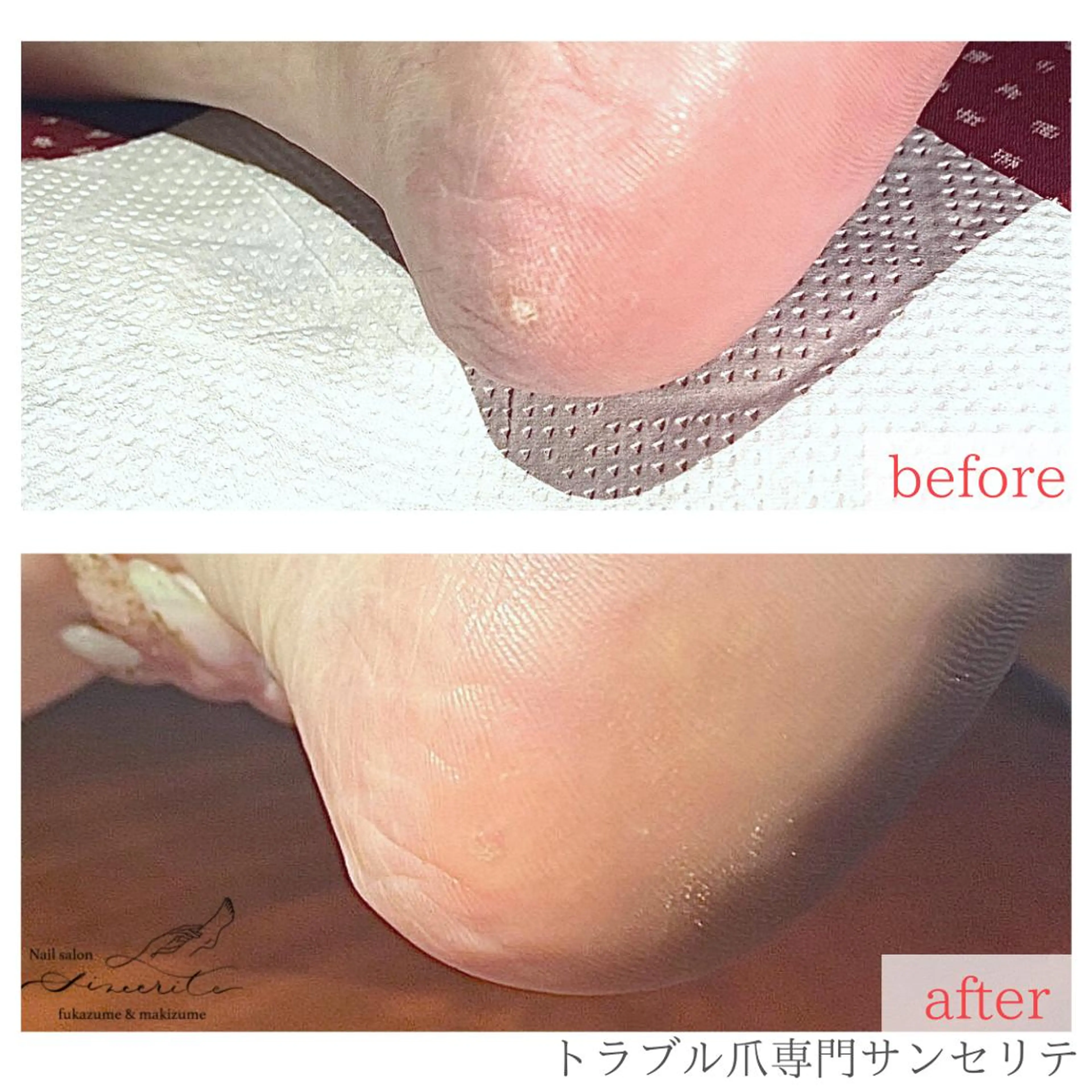 ネイル 深爪・巻き爪 専門サンセリテのネイルデザイン