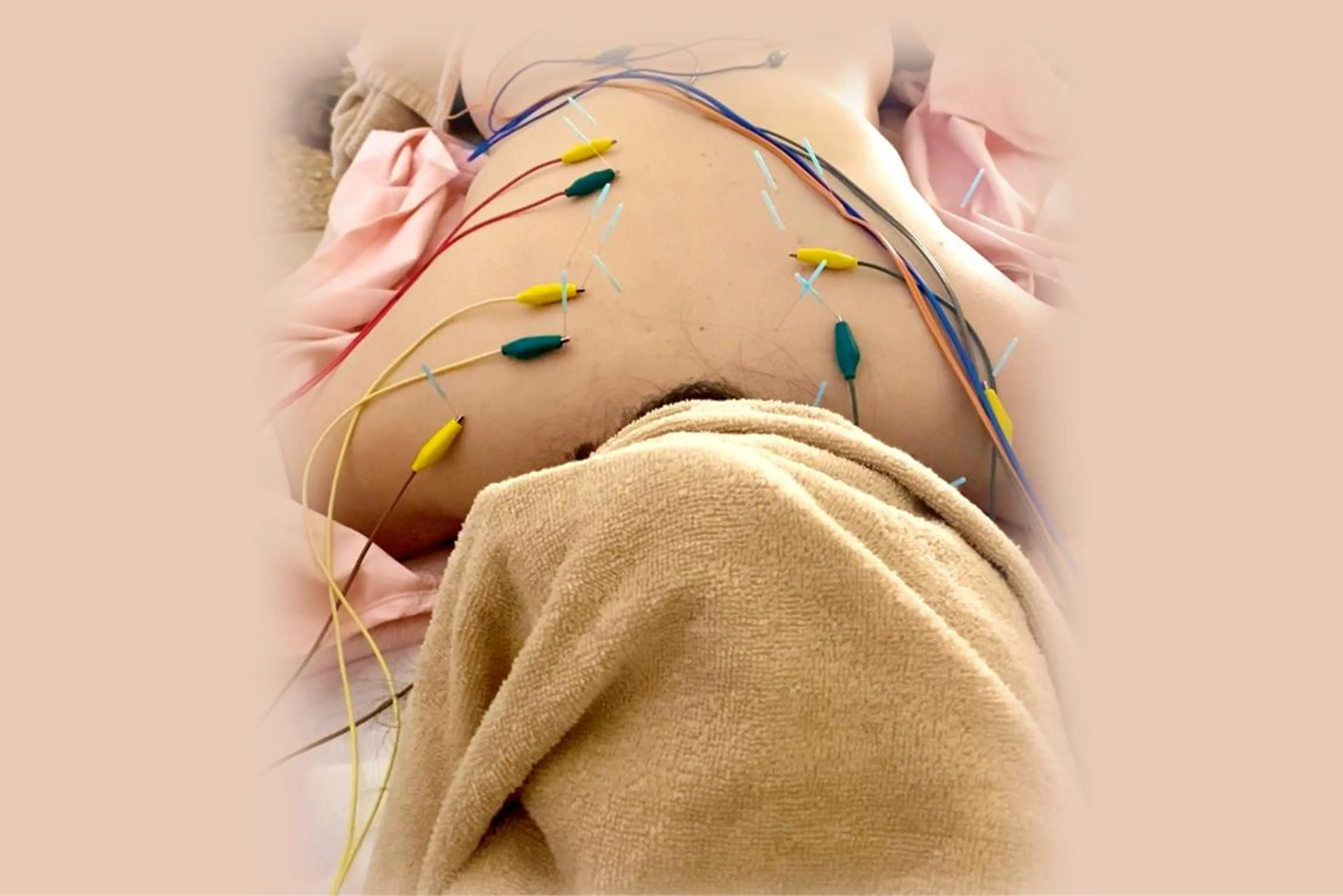 お顔とお体の美容鍼の写真