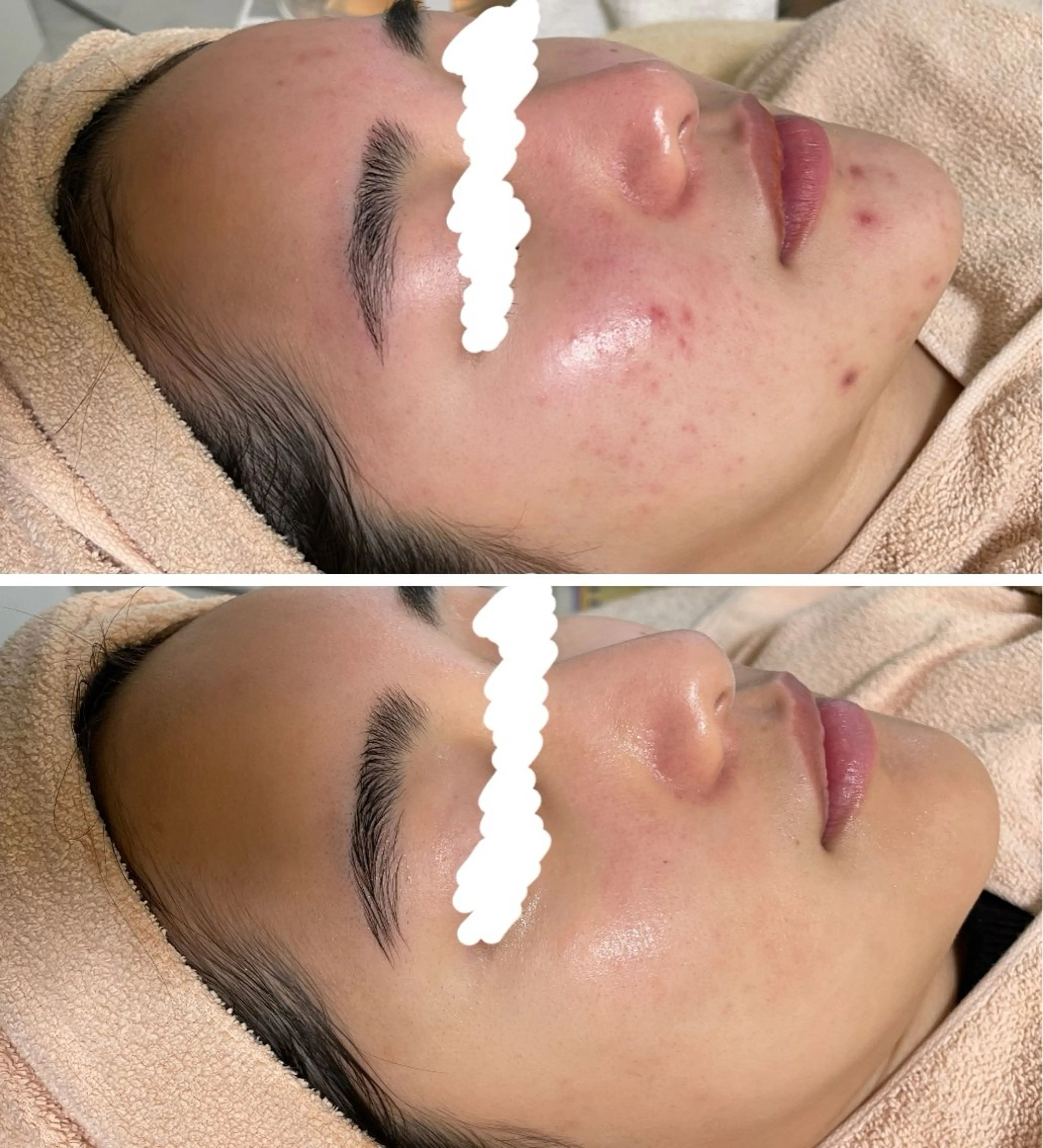 エステ ニキビ&跡改善サロン オーナー光木のエステ・リラクイメージ