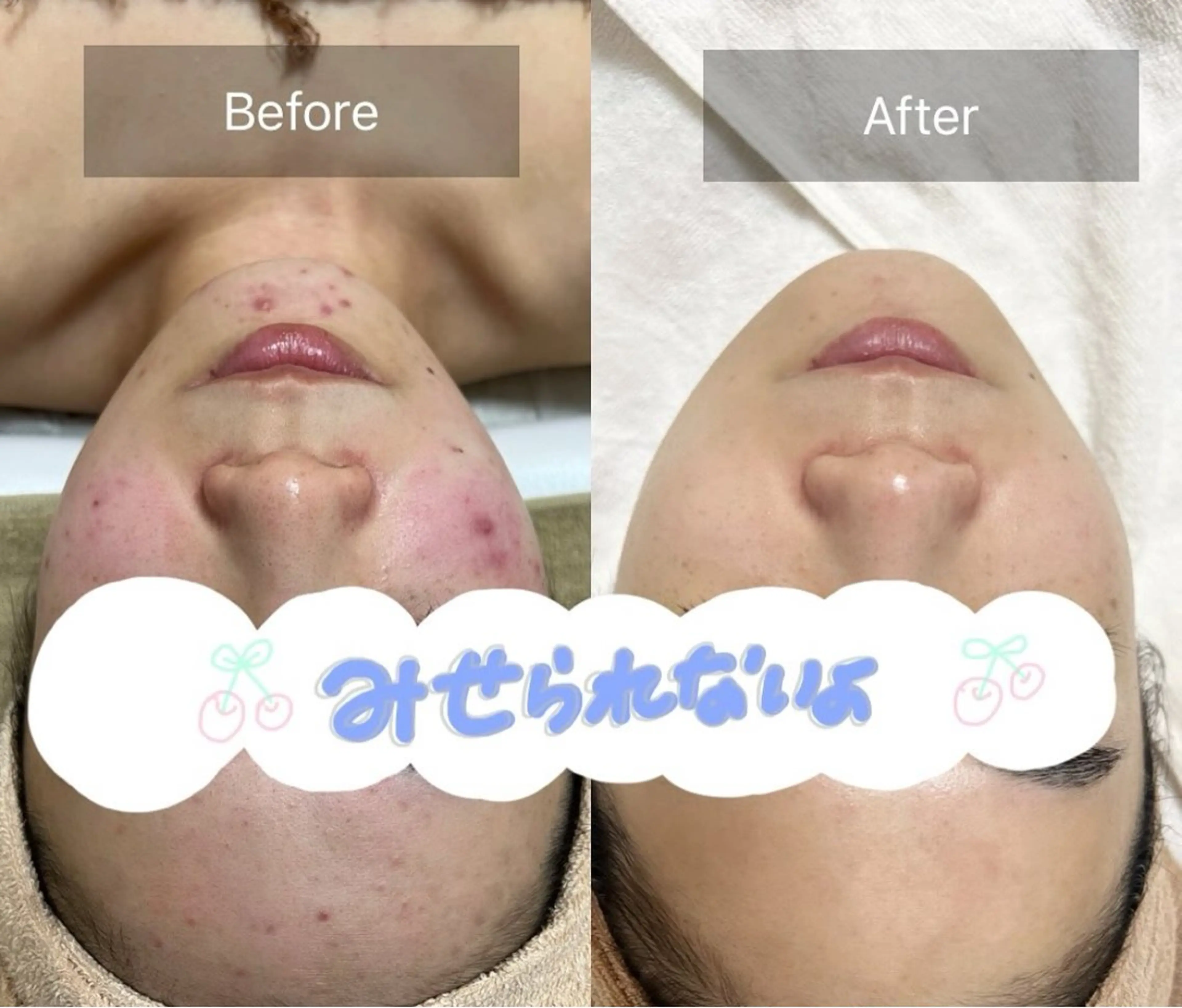 ニキビ・ニキビ跡ならLACマスク➕クールパックで決まり！！！の写真