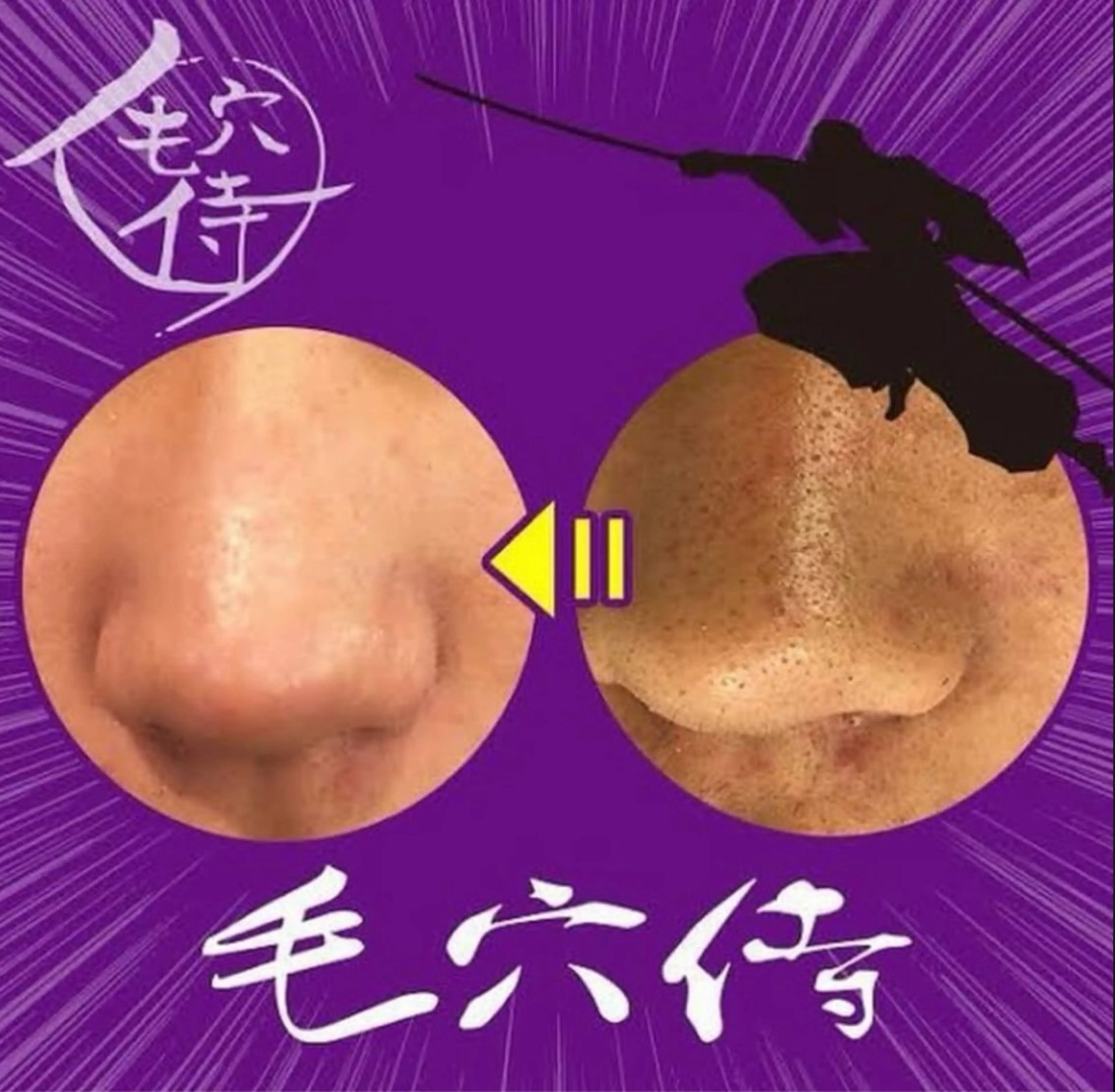 【毛穴侍＆松ヤニパック】 毛穴撲滅コース！毛穴の黒ずみ悩みはこれ！の写真