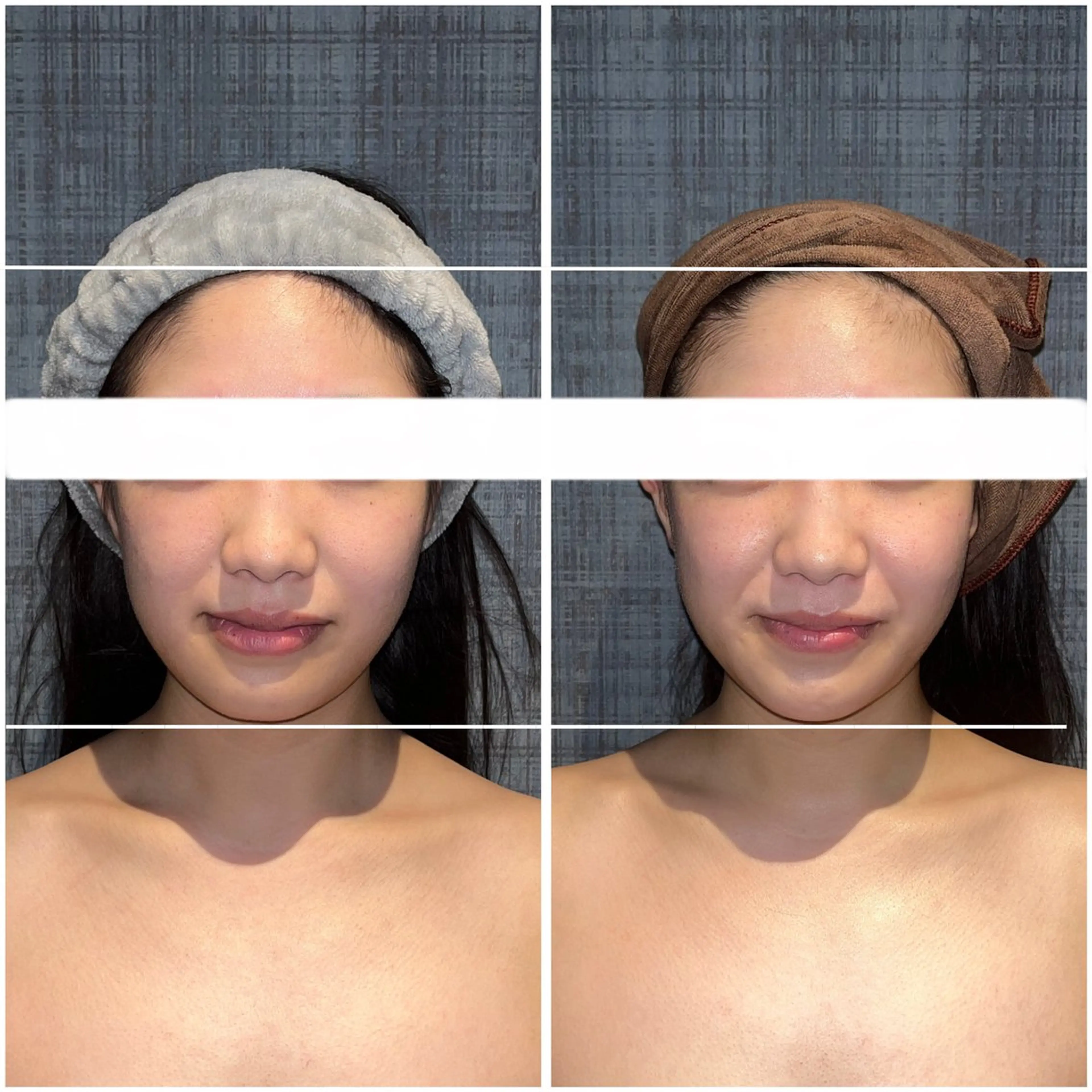 🌼モニター募集🌼ぽにょ取り✖️こりとりコルギのセットメニュー❣️最強の小顔はこれ一択です💀💛の写真