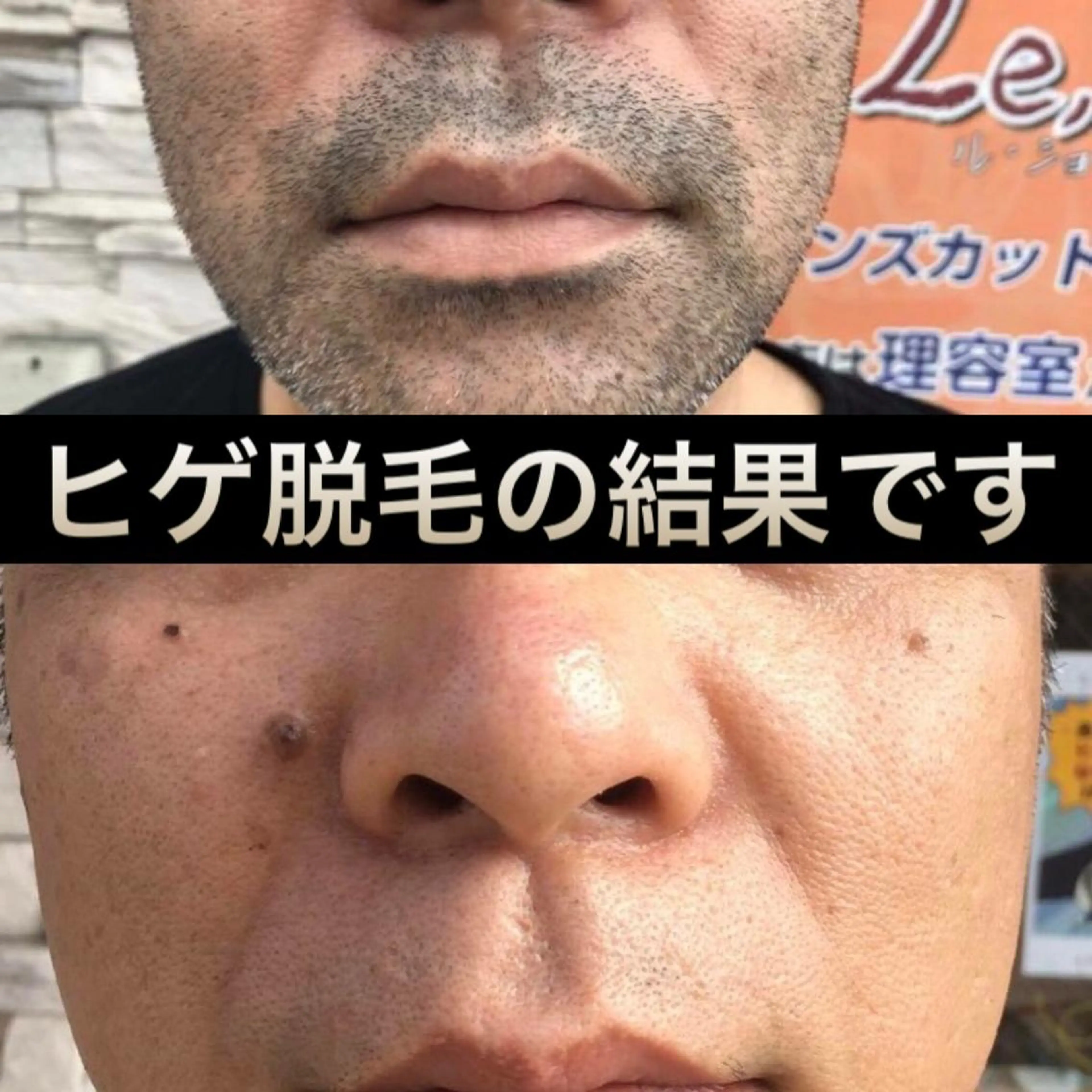 ヒゲ脱毛の写真