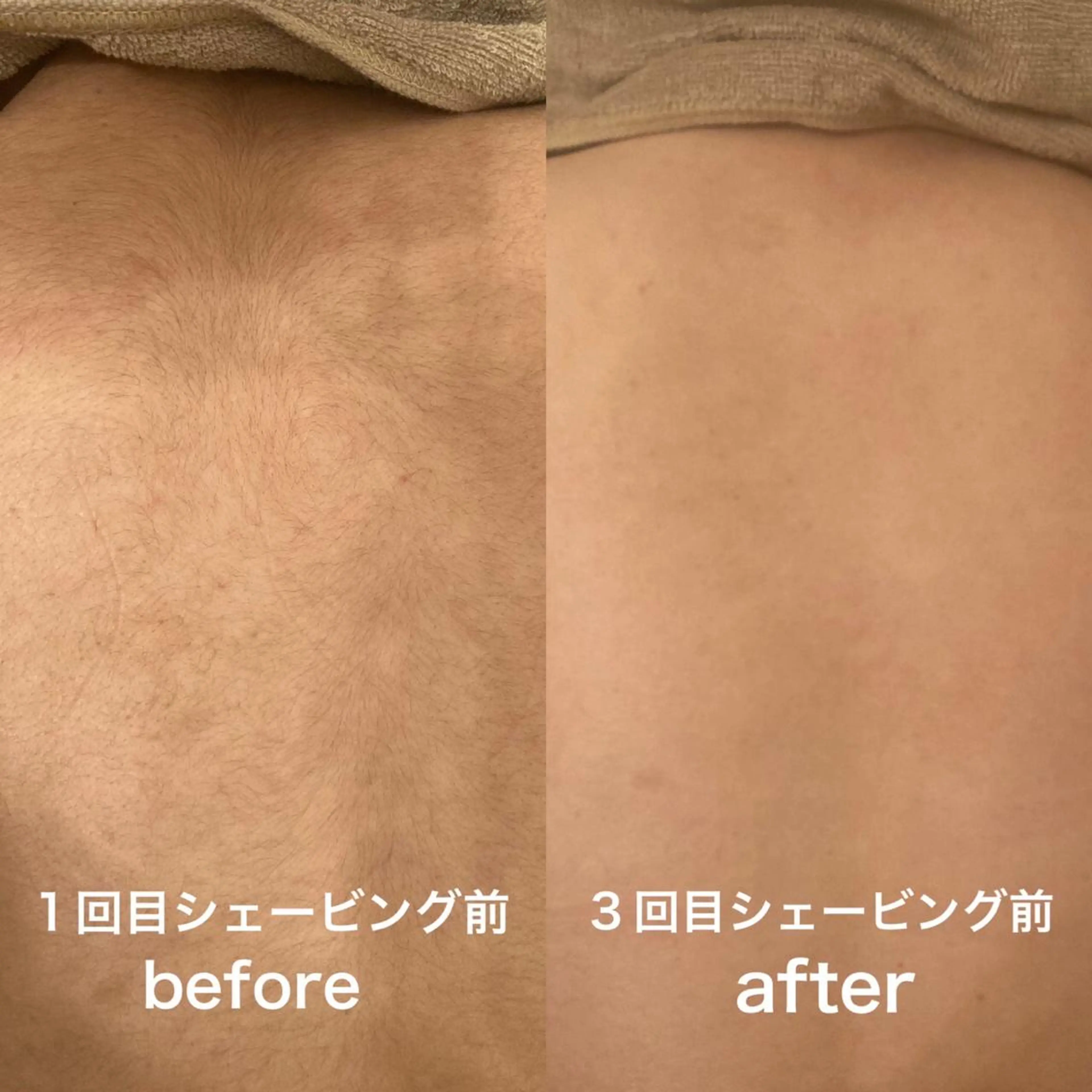 夏に大人気♥️背中＋うなじ脱毛✨シェービング無料🎶の写真