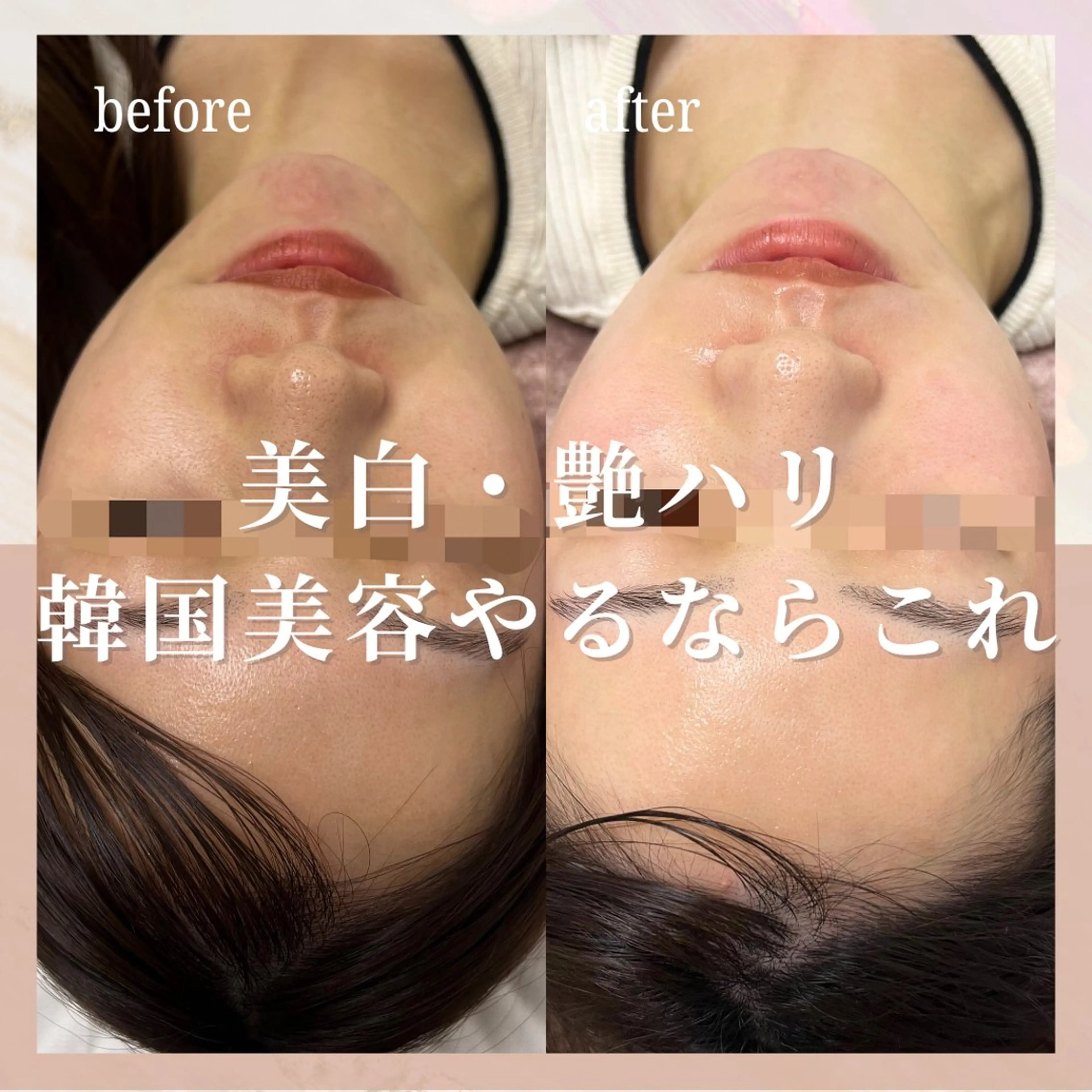 エステ 🎀韓国式肌改善🎀 Miku🇰🇷💎のその他イメージ