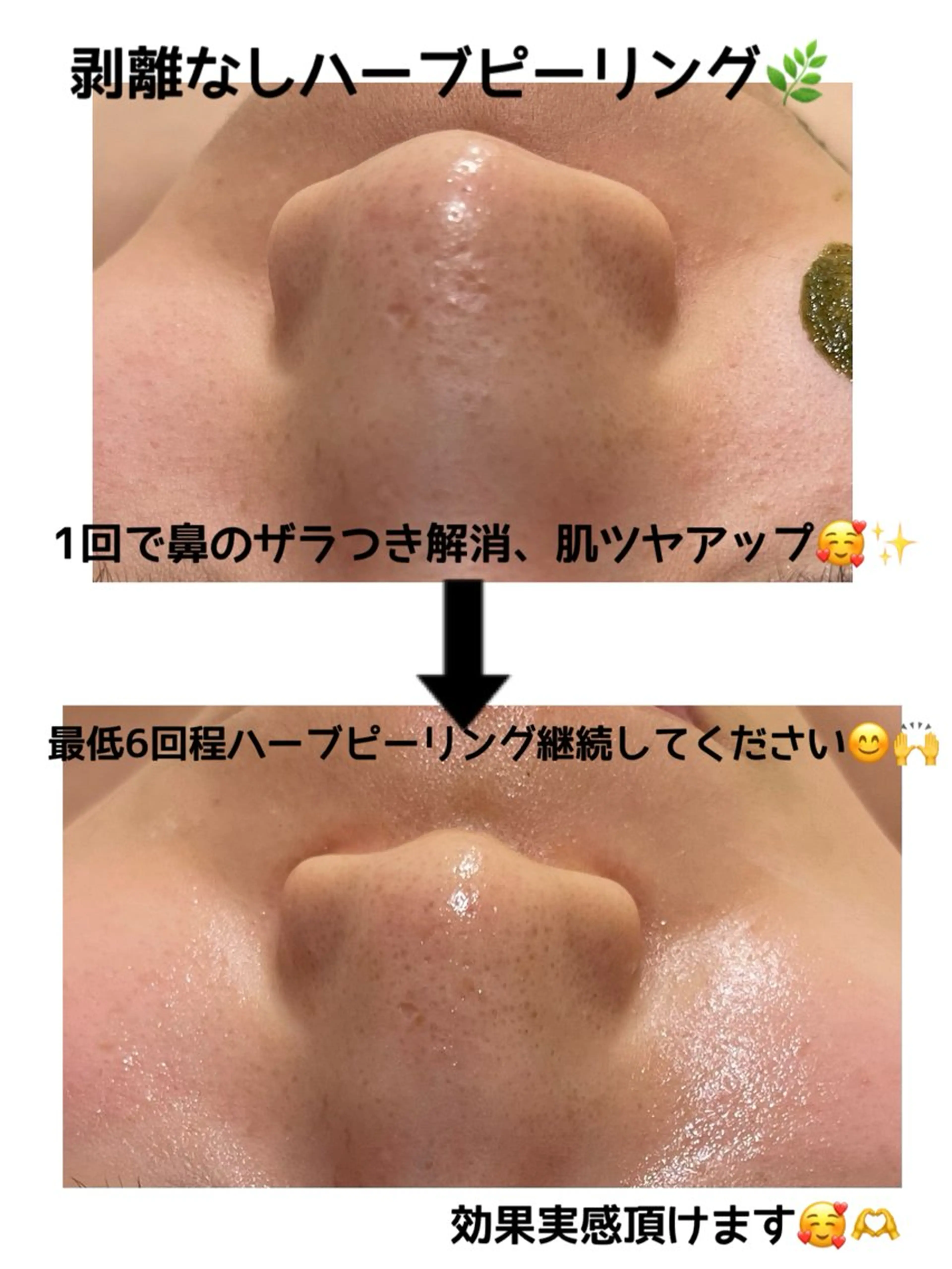 【剥けないハーブピーリング】ダウンタイム無いですの写真