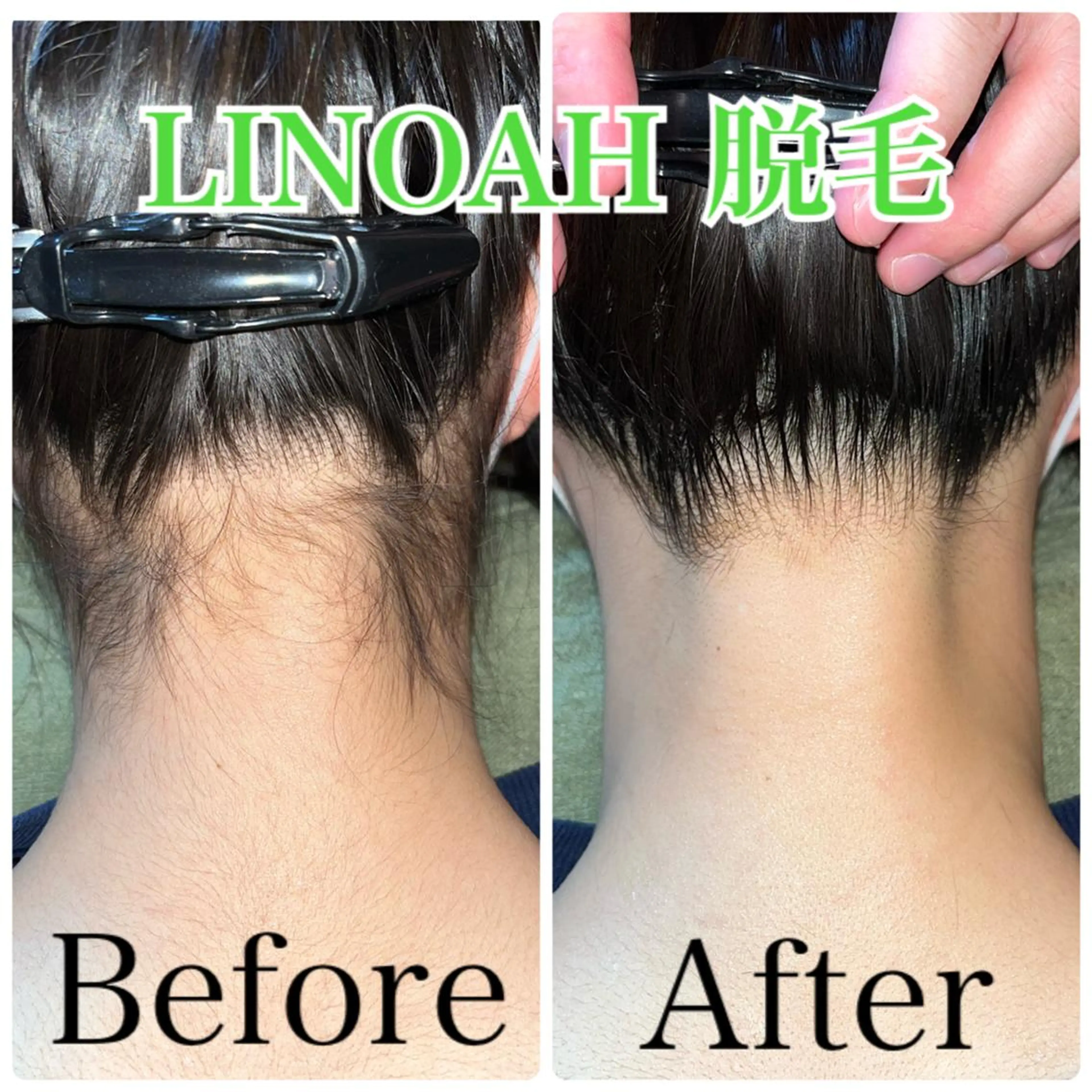 ◎12月限定◎【毛穴/ムダ毛改善】うなじ脱毛 シェービング付き ￥4180⇒¥3000の写真