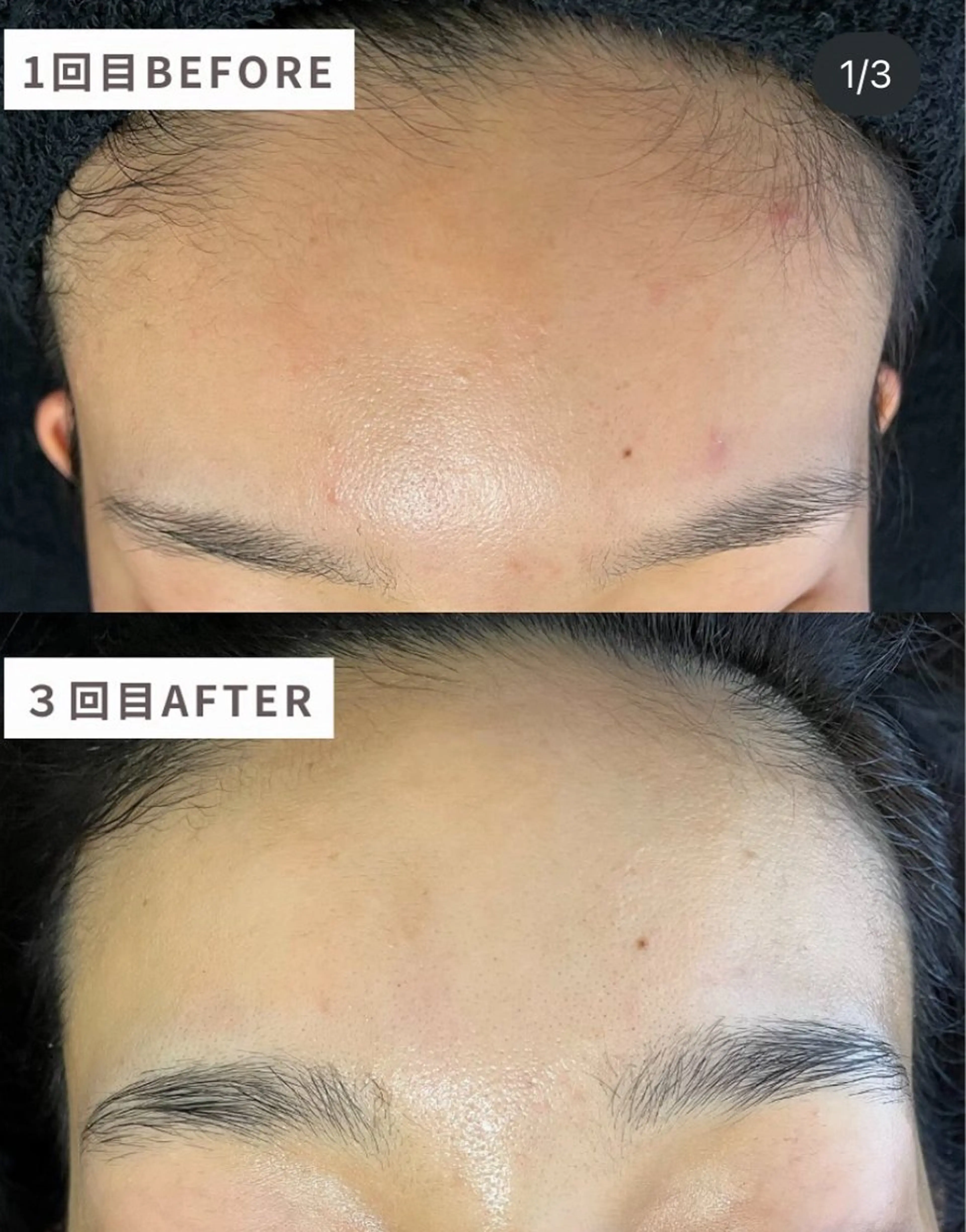 部分REVIハーブピーリング+たっぷり全顔炭酸ガスパック(芸能人多数愛用)💖の写真