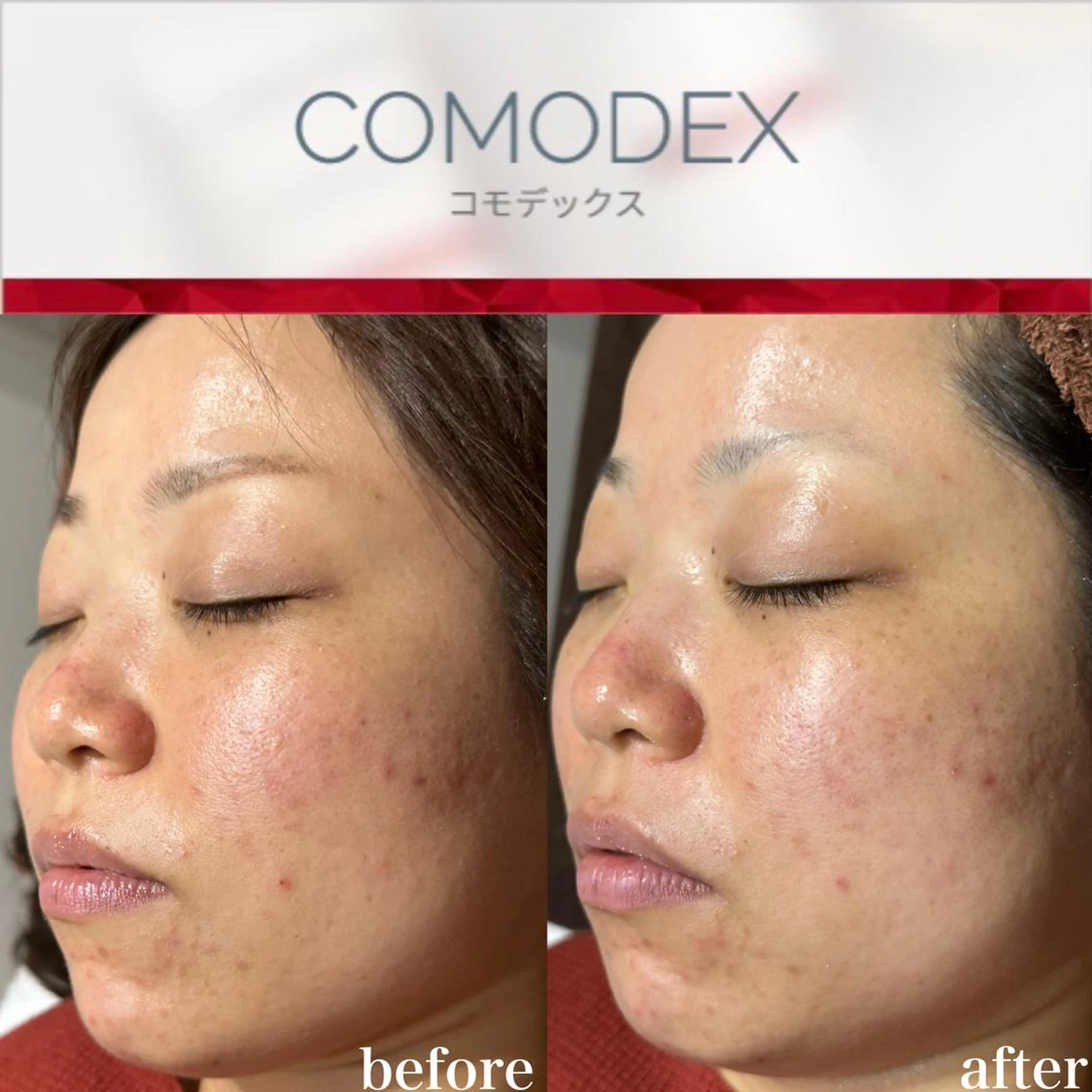 mieux所属・ハーブピーリング ¥6600のエステ・リラクイメージ