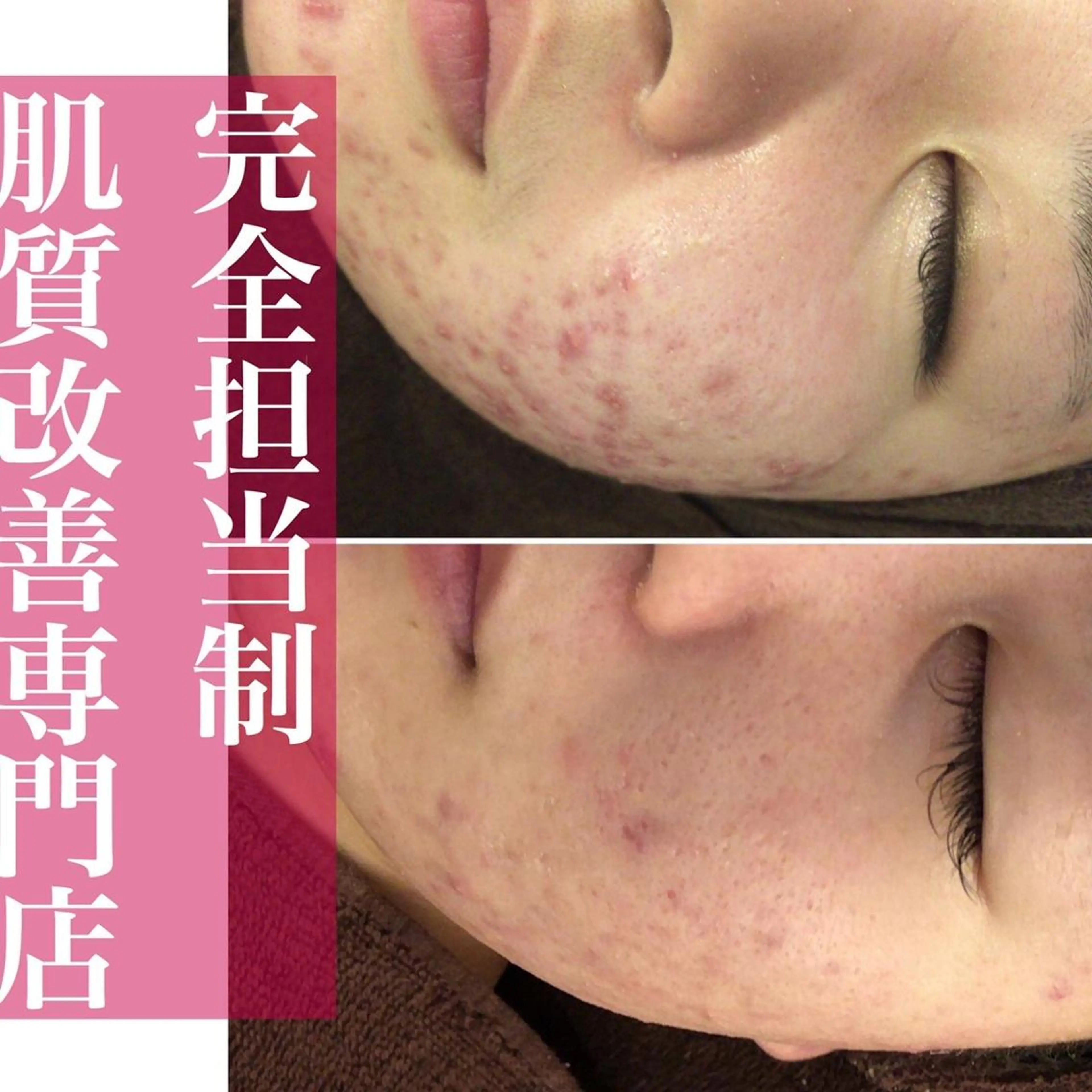 夏までに肌荒れ卒業 するサロン🌻のエステ・リラクイメージ