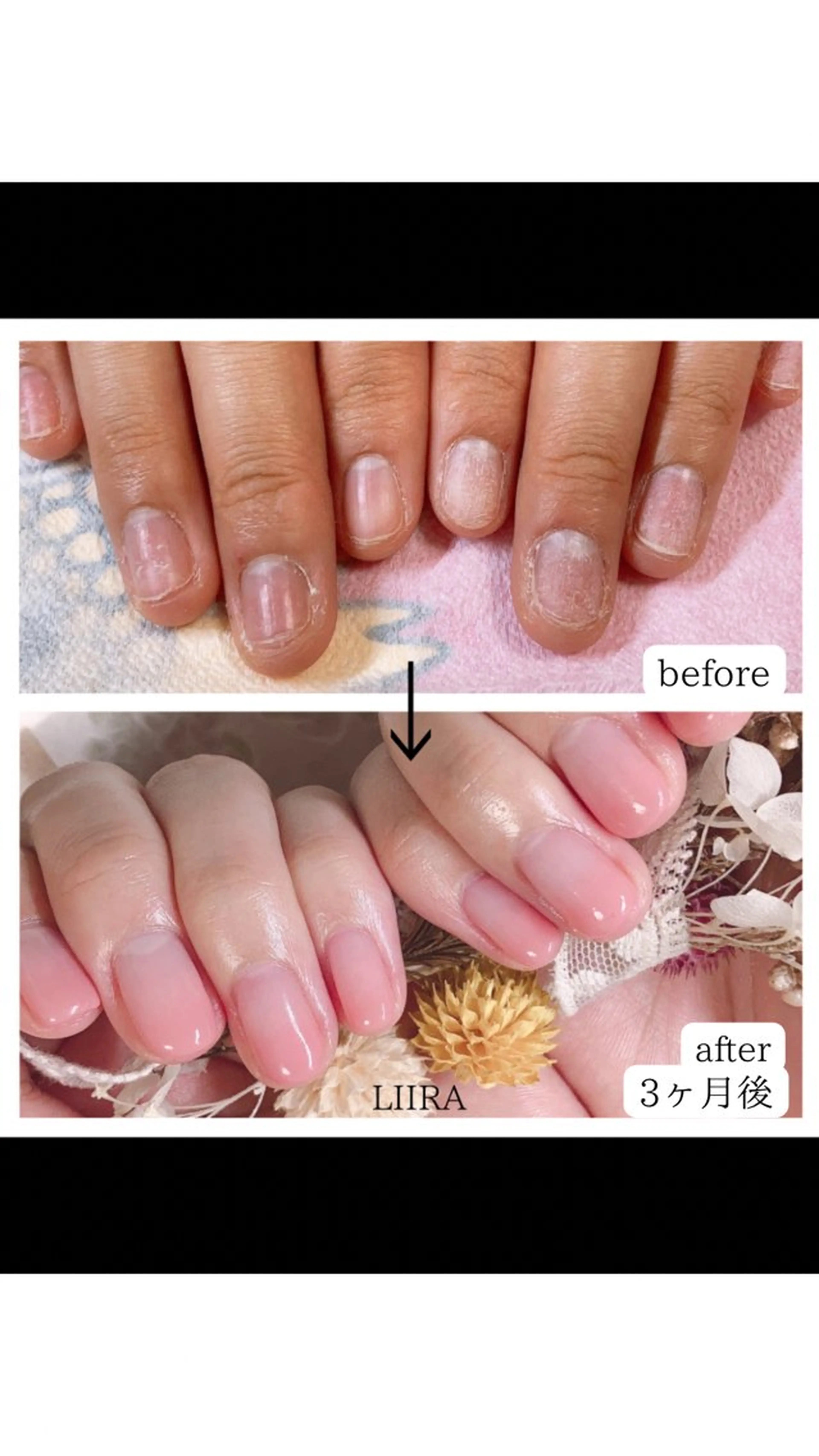 育爪✨噛み癖、いじり癖、２枚爪、乾燥爪などの矯正の写真